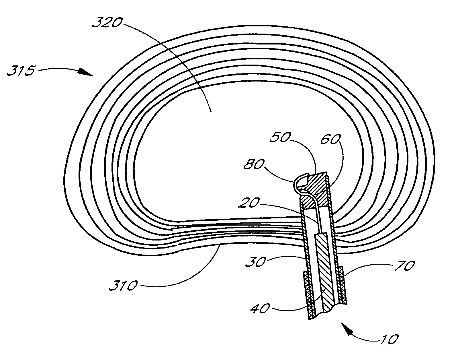 Minimally invasive system for manipulating intervertebral disc tissue