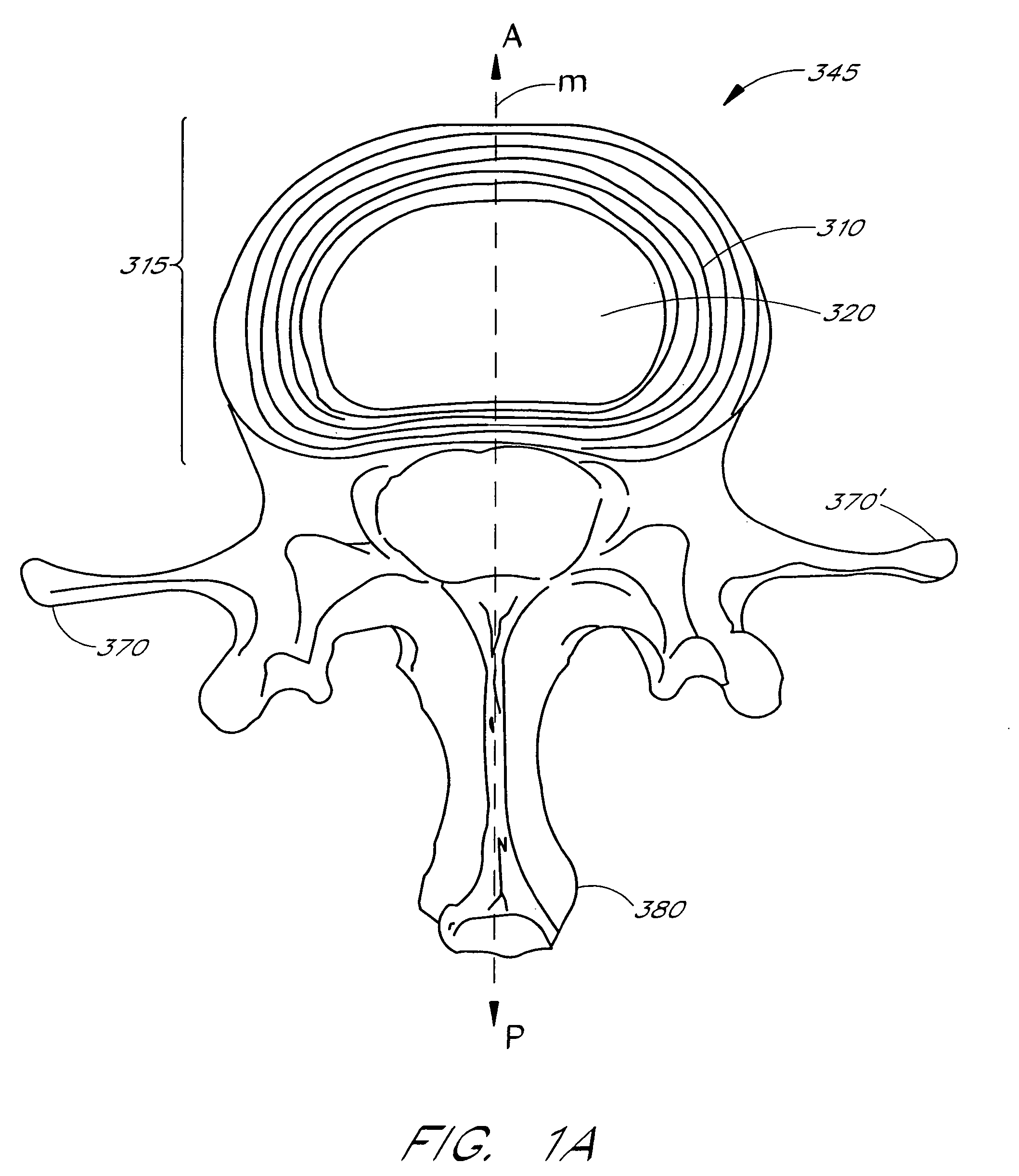 Minimally invasive system for manipulating intervertebral disc tissue