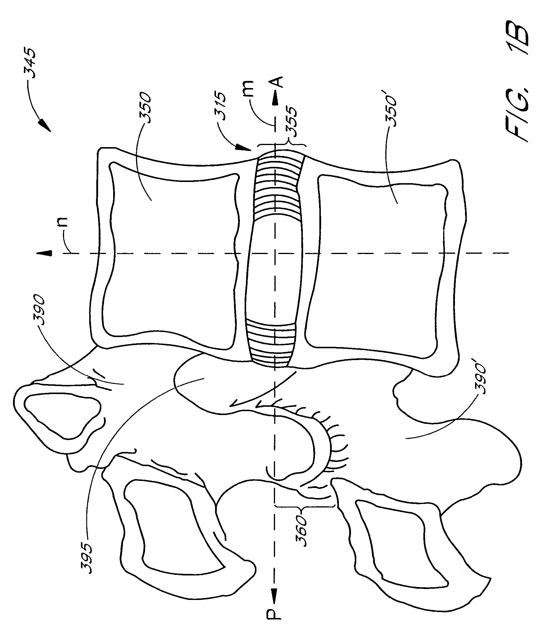 Minimally invasive system for manipulating intervertebral disc tissue