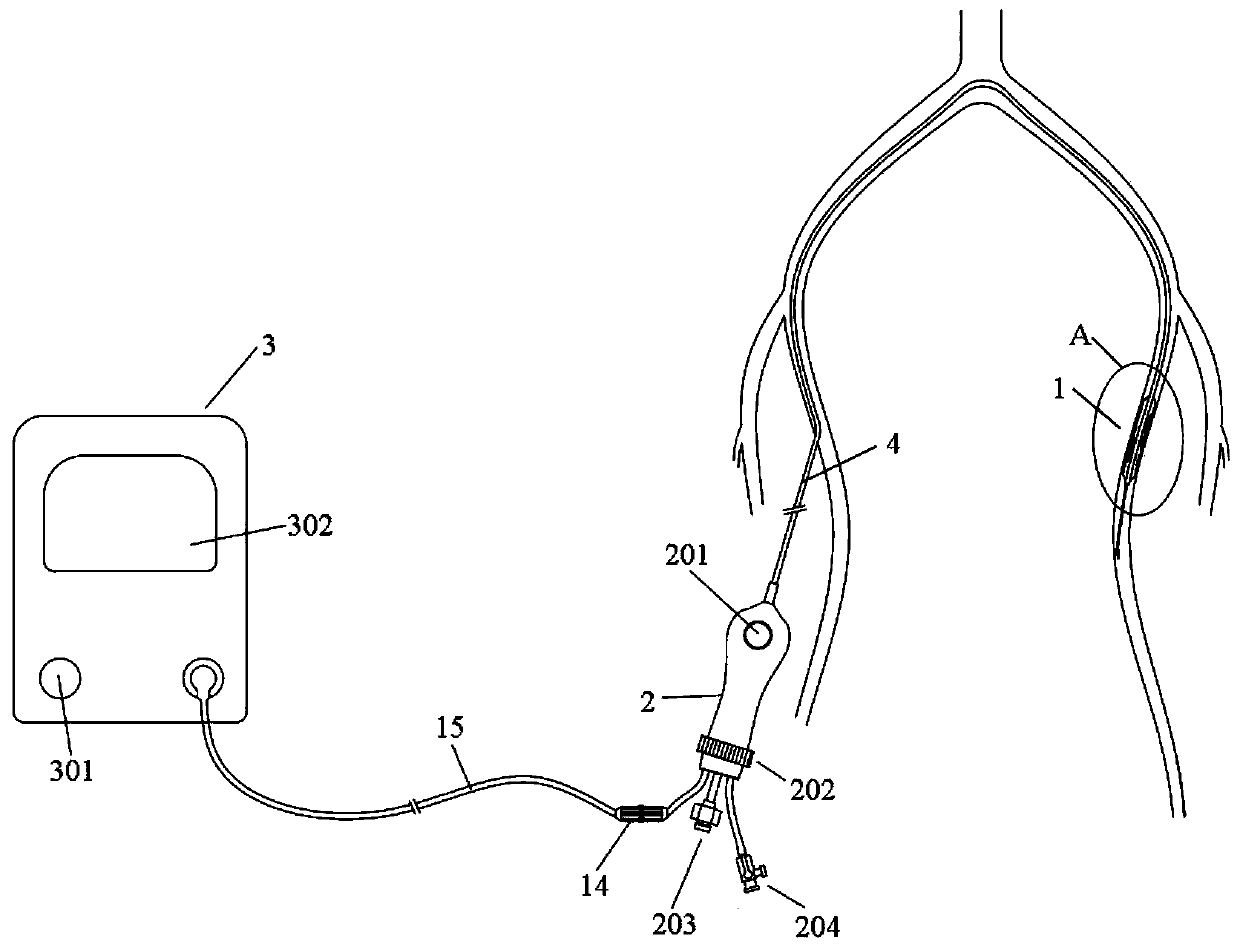 Vascular recanalization system for cardiovascular stenosis lesions