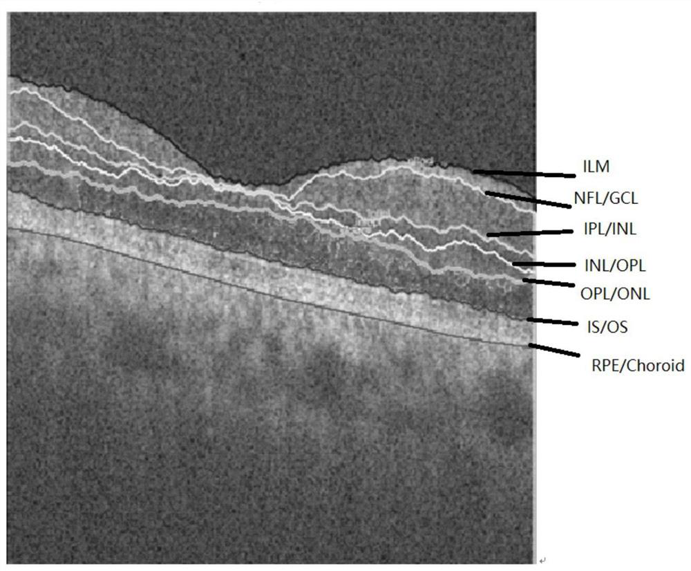 A Method for Retinal Layering in Fundus OCT Images