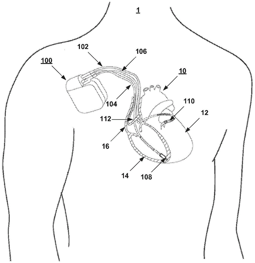 Assessing intra-cardiac activation patterns