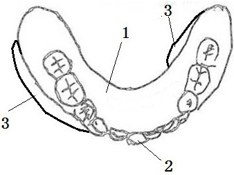 Full-mouth denture base suitable for serious undercut deformity of jawbone and manufacturing method thereof