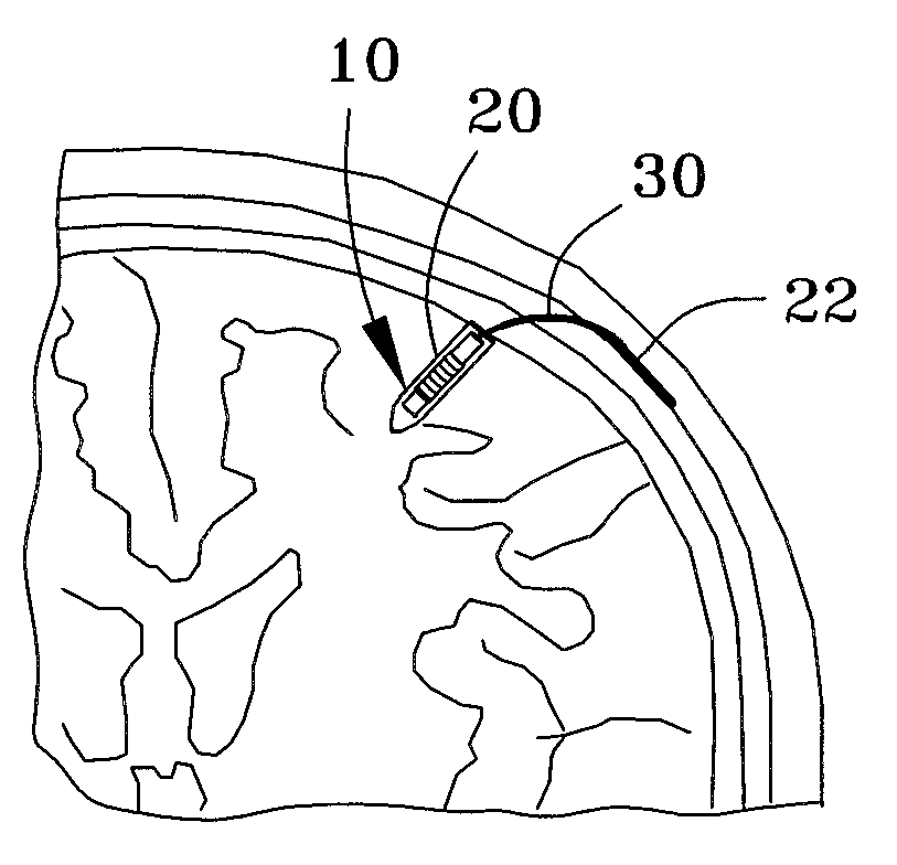 Miniature wireless system for deep brain stimulation