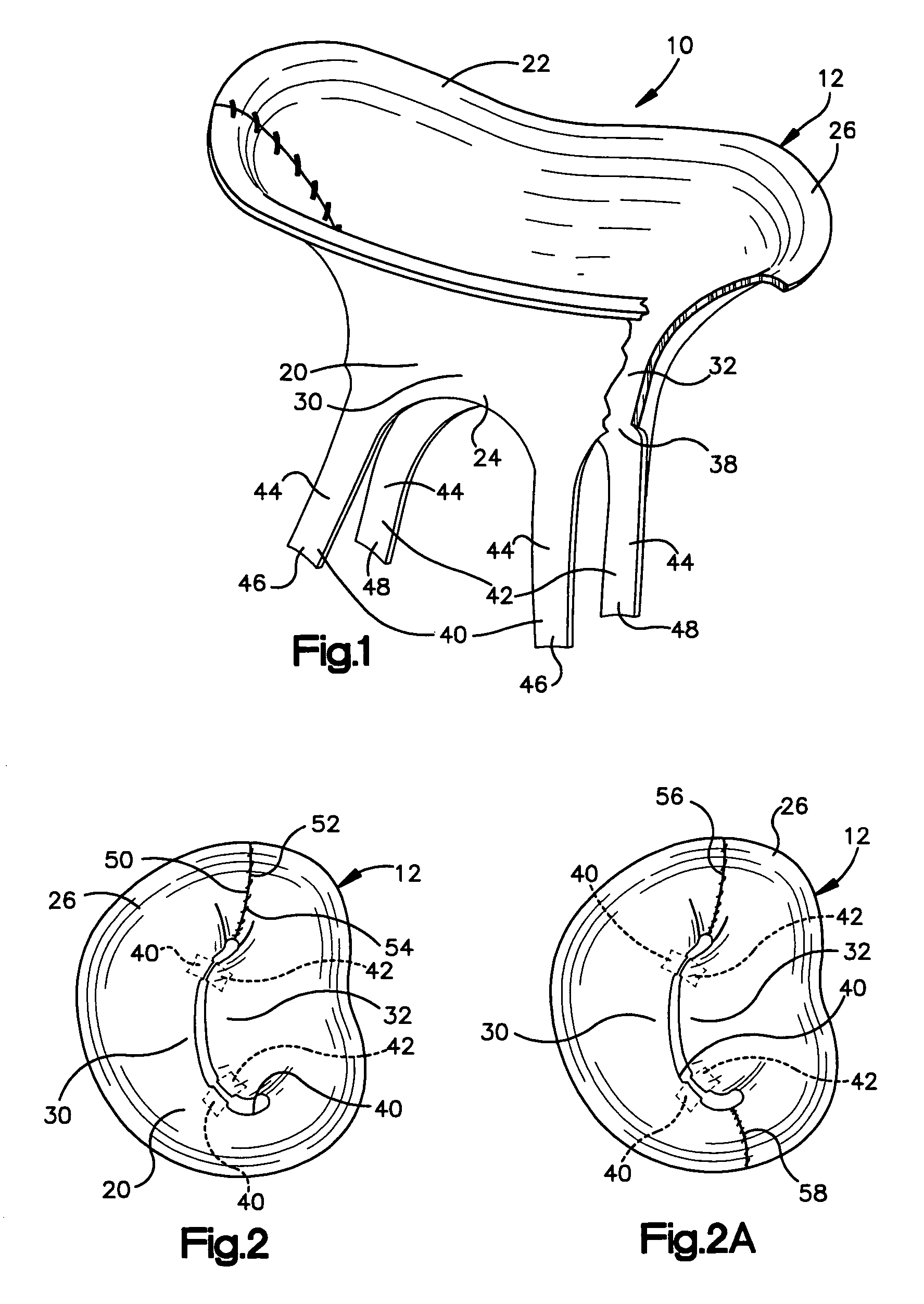 Stentless bioprosthetic valve having chordae for replacing a mitral valve