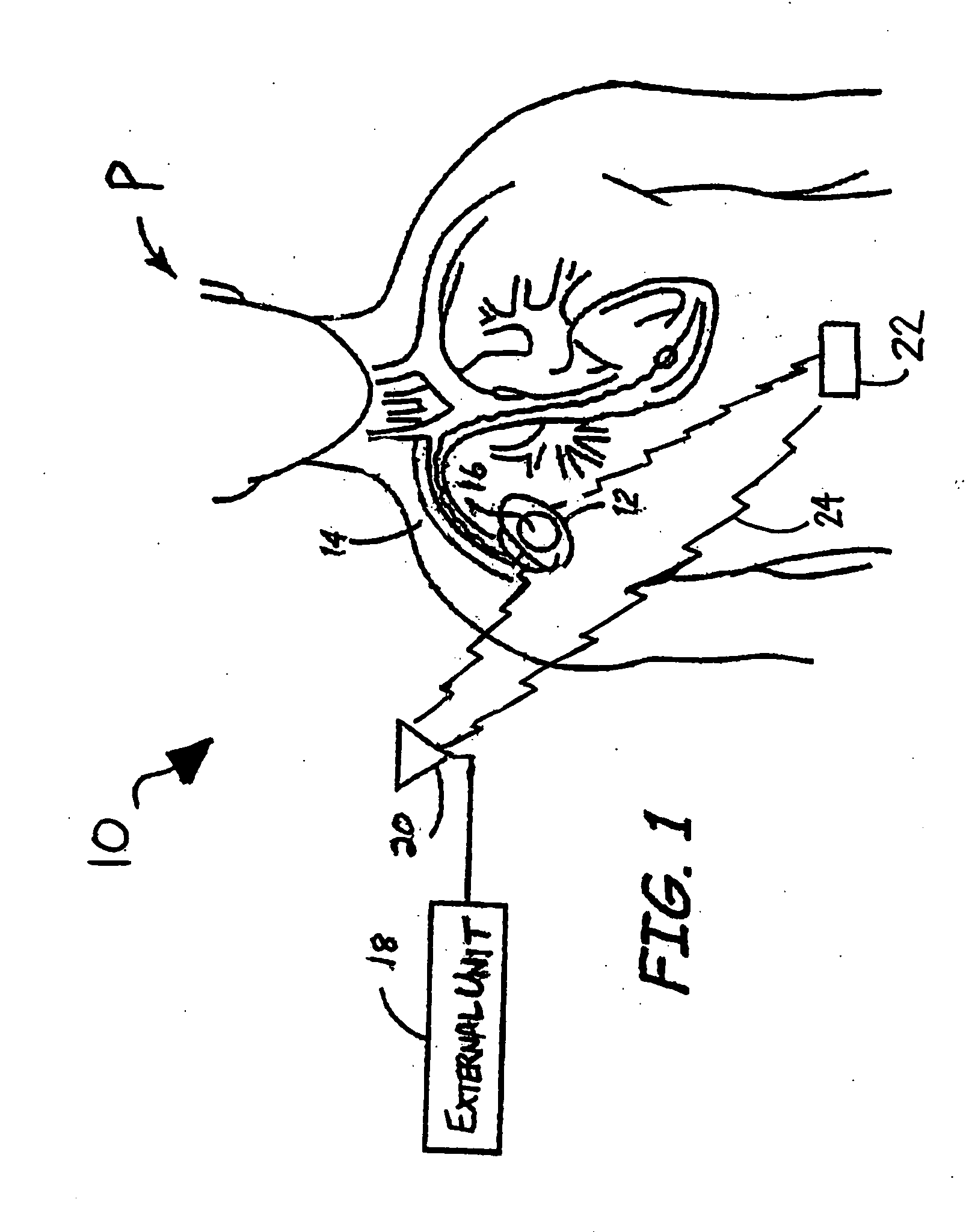 System and method for synchronous wireless communication with a medical device