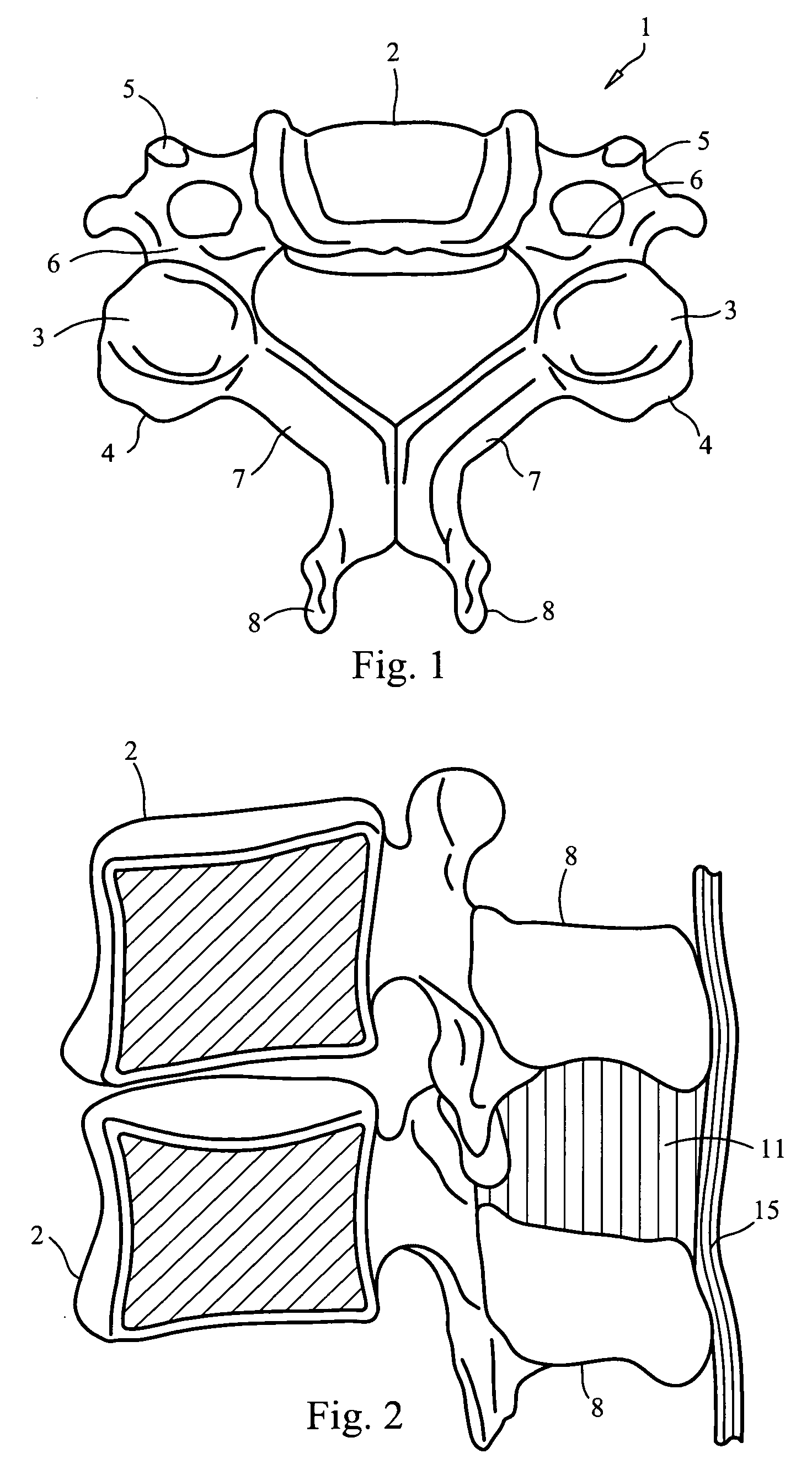 Interspinous implant, tools and methods of implanting