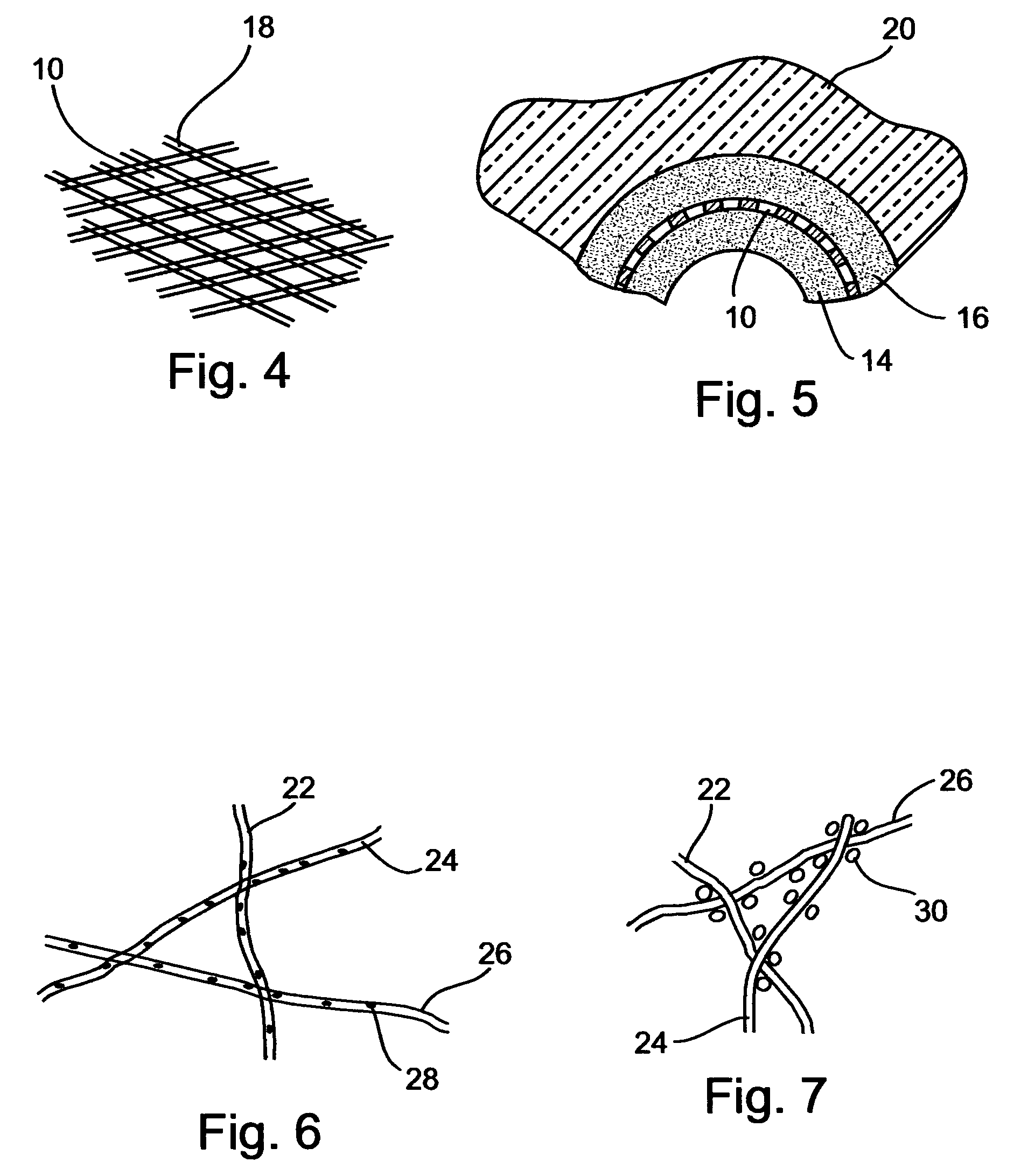 Medicated polymer-coated stent assembly