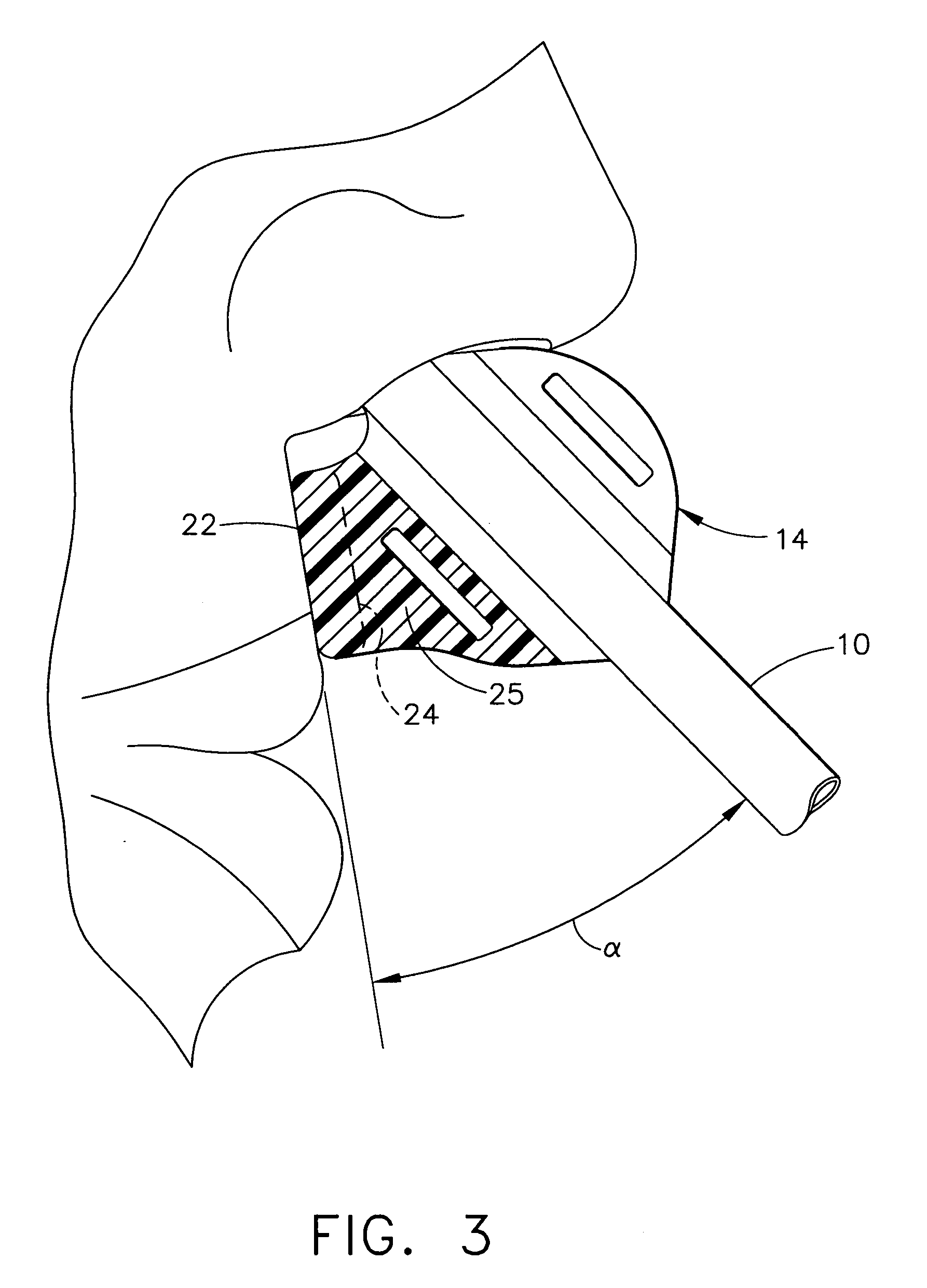 Adjustable collar and retainer for endotracheal tube