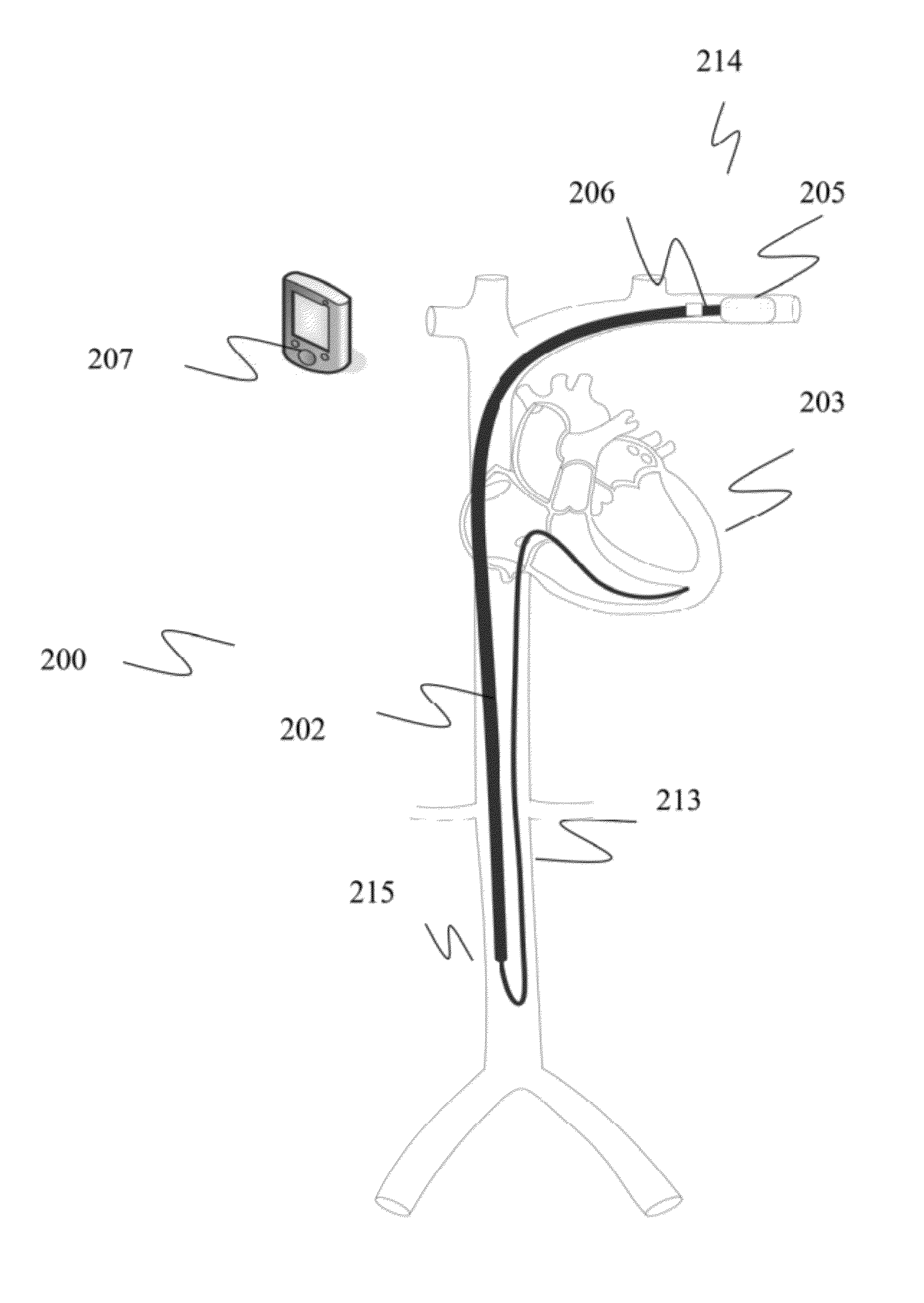 Dislodgement detector for intravascular implantable medical device