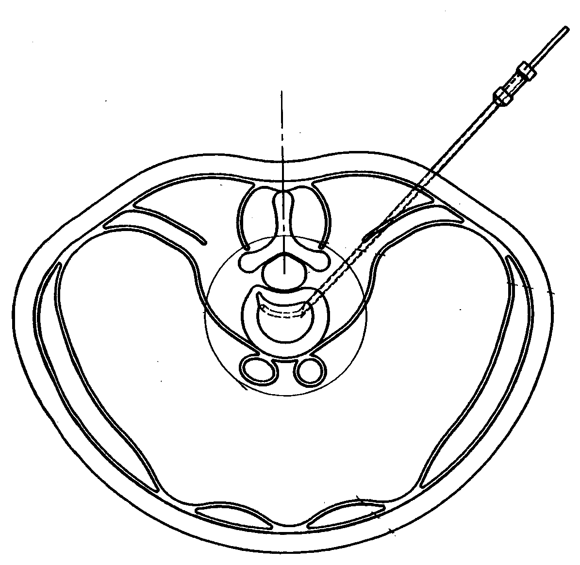 Contralateral insertion method to treat herniation with device using visualization components