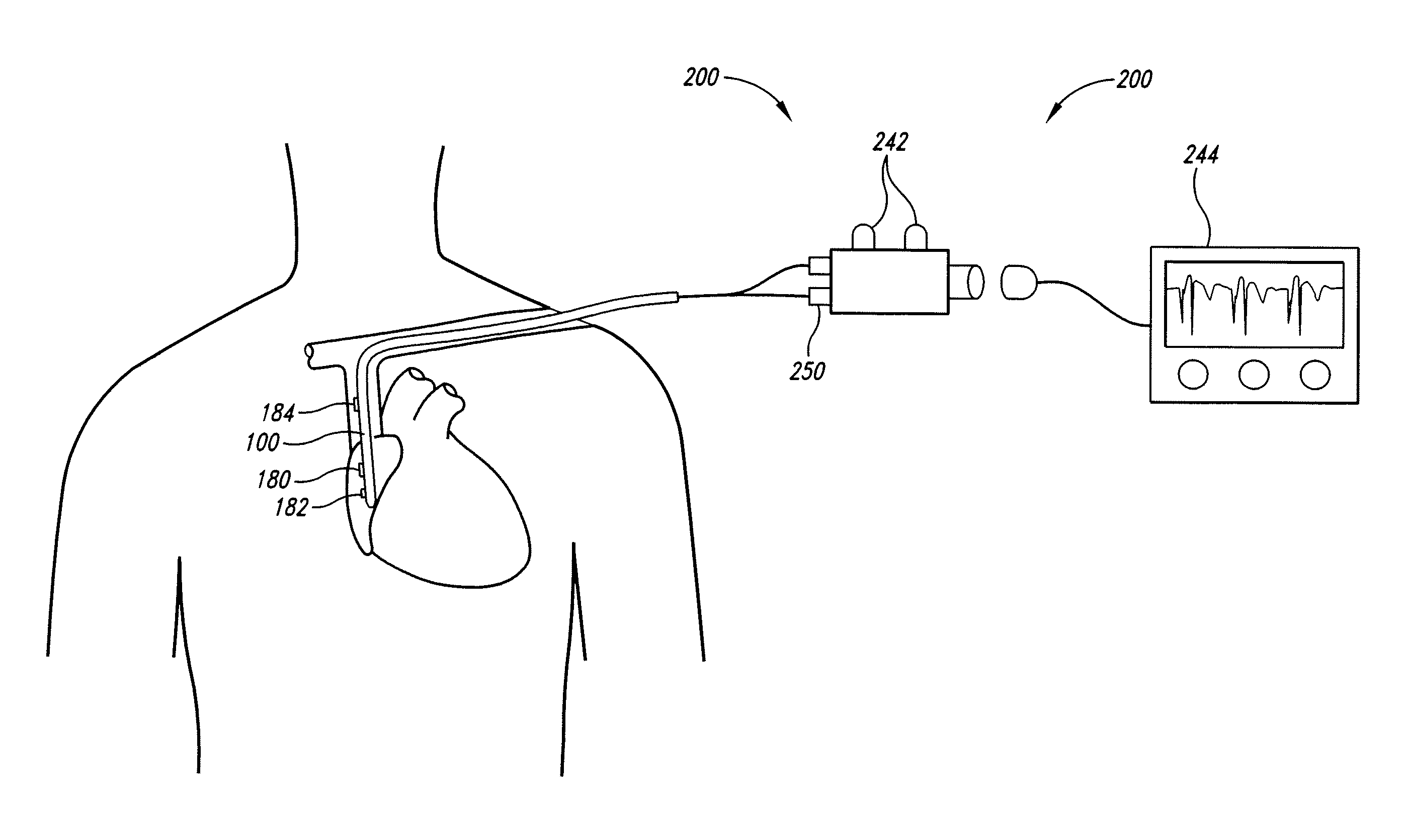 Method of locating the tip of a central venous catheter