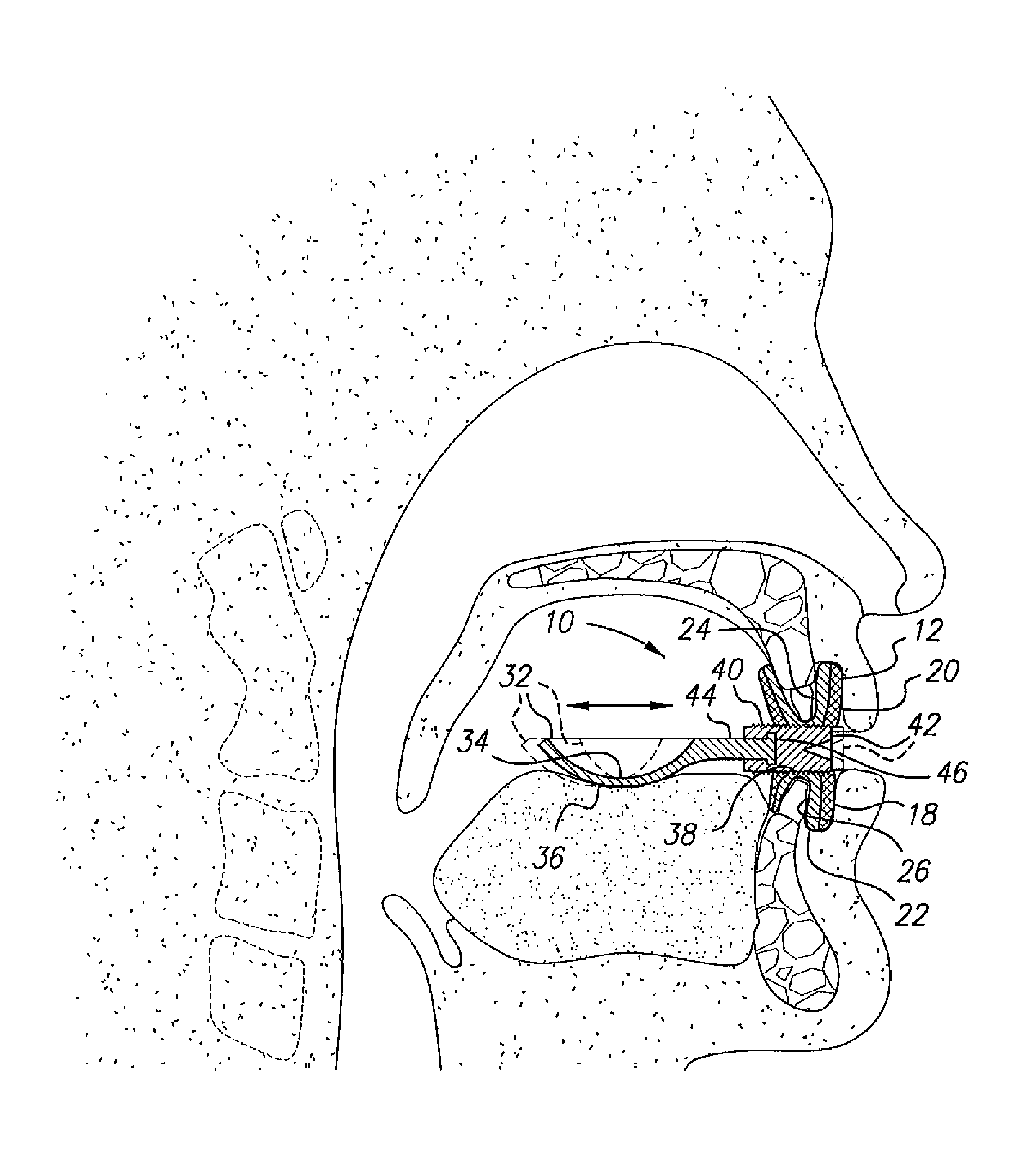 Oral appliance for the treatment of sleep apnea