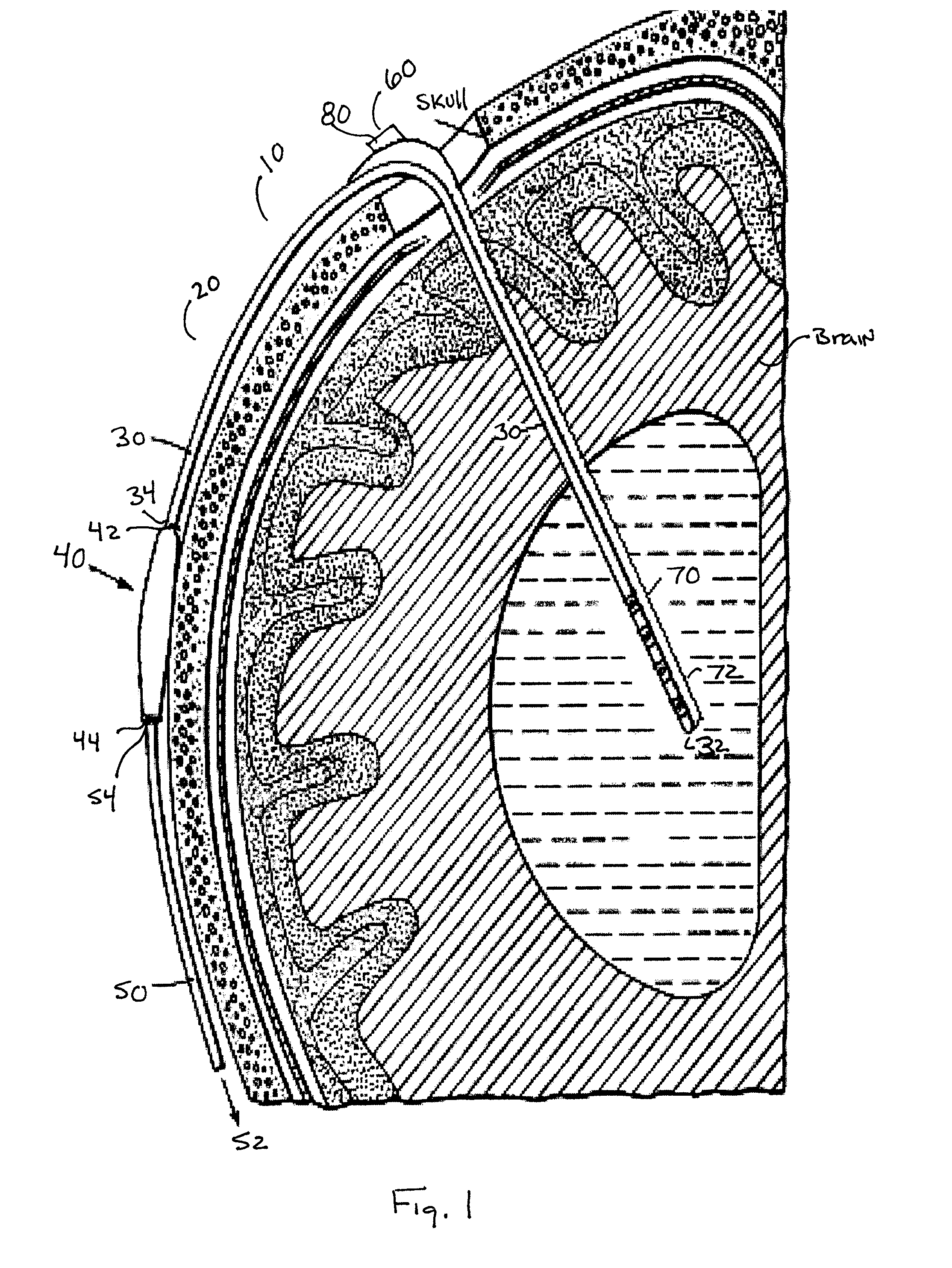 Ventricular shunt system and method