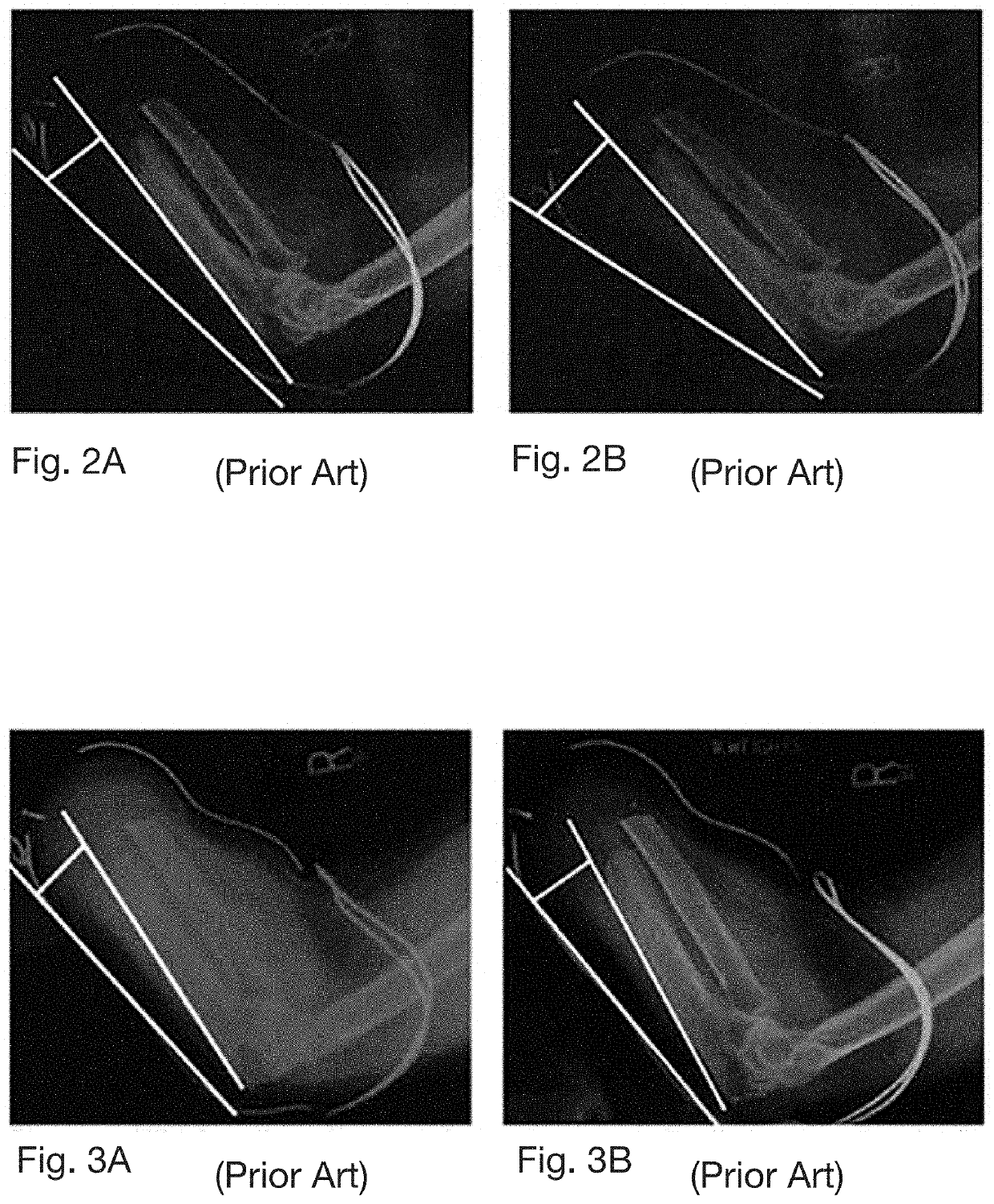 Variable compliance prosthetic socket with breathable matrix