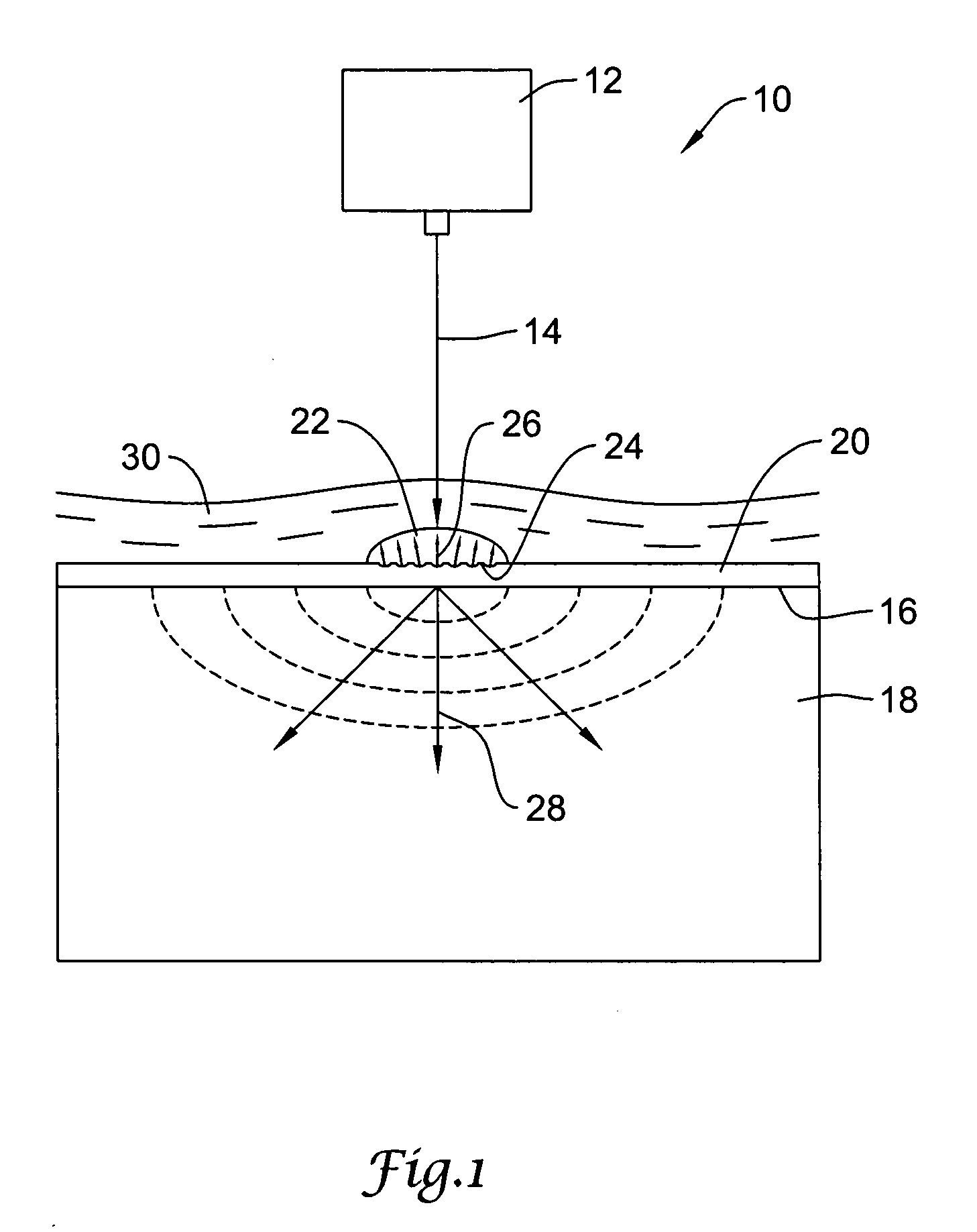 Laser shock peening of medical devices