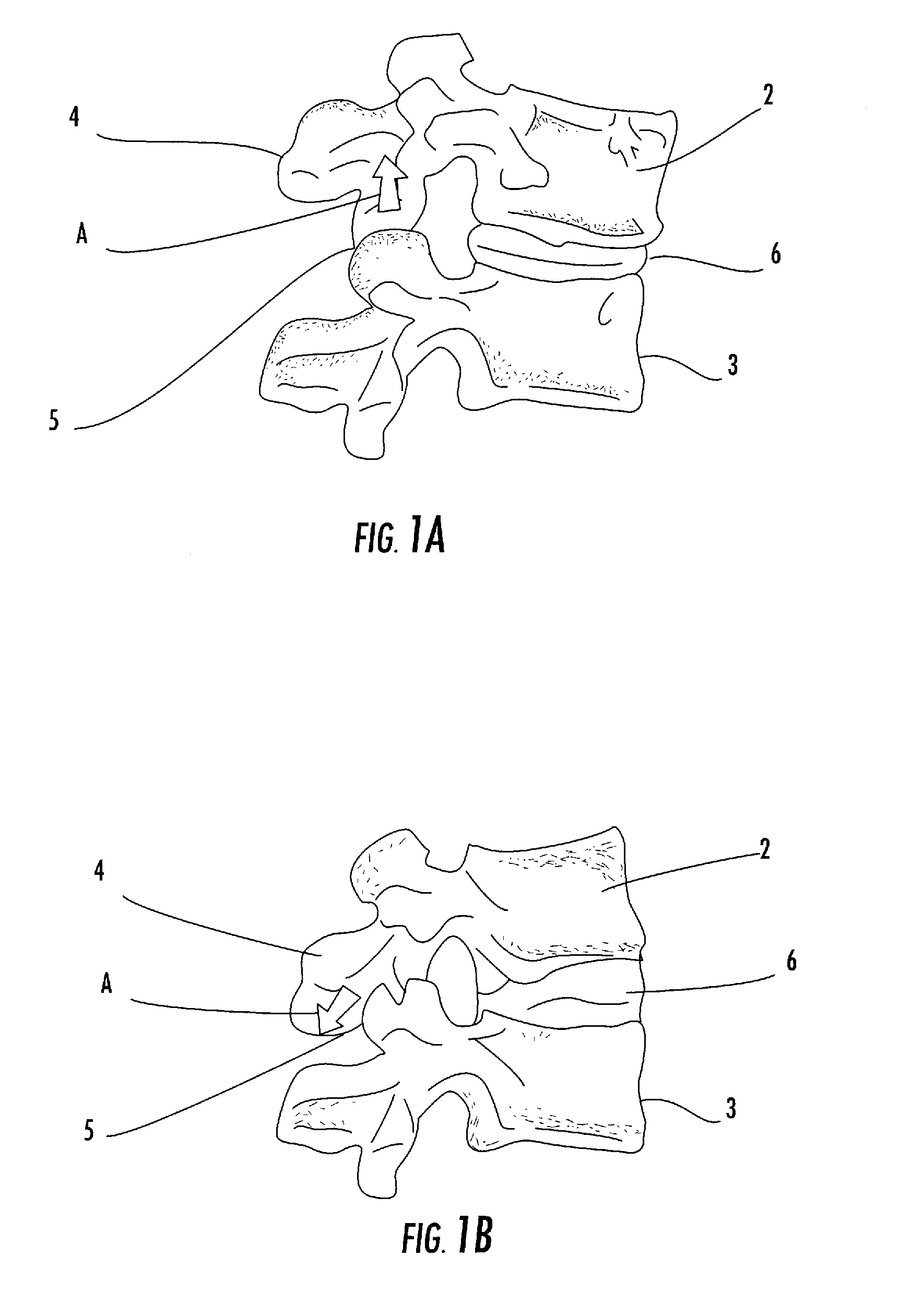 Connecting rod for bone anchors having a bioresorbable tip