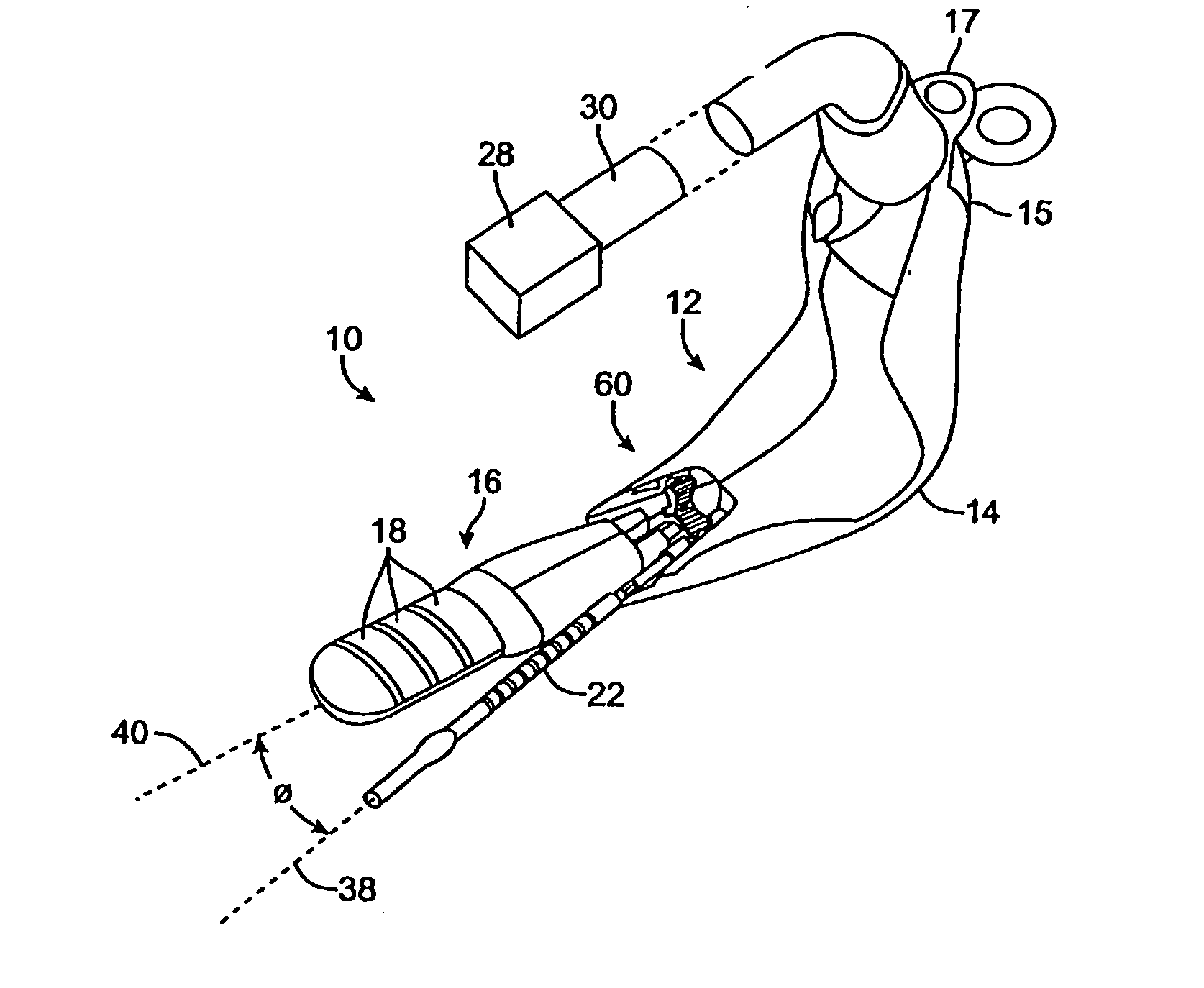 Incontinence treatment with urethral guide