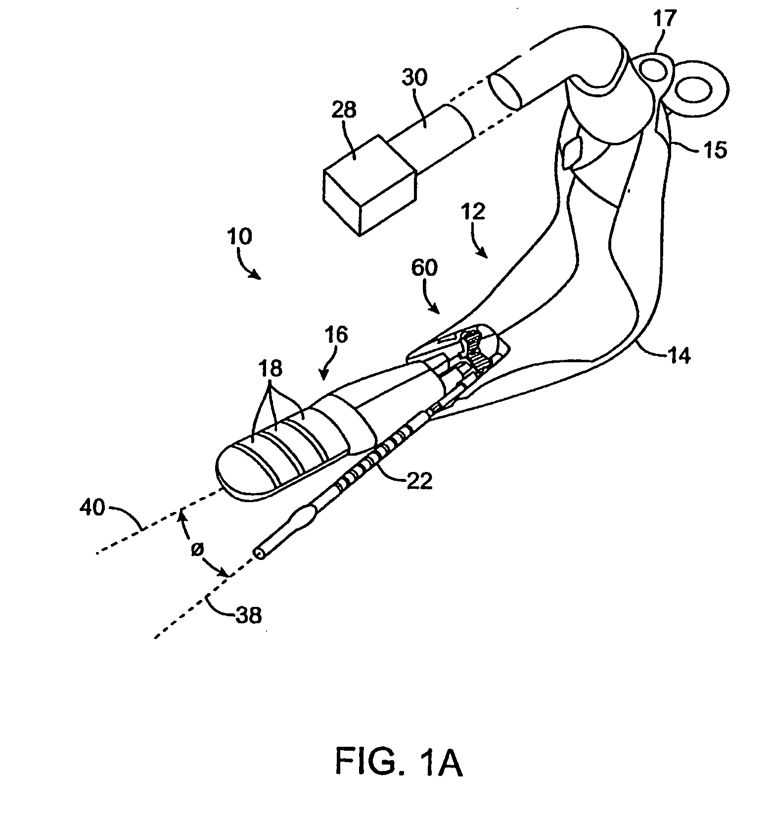 Incontinence treatment with urethral guide