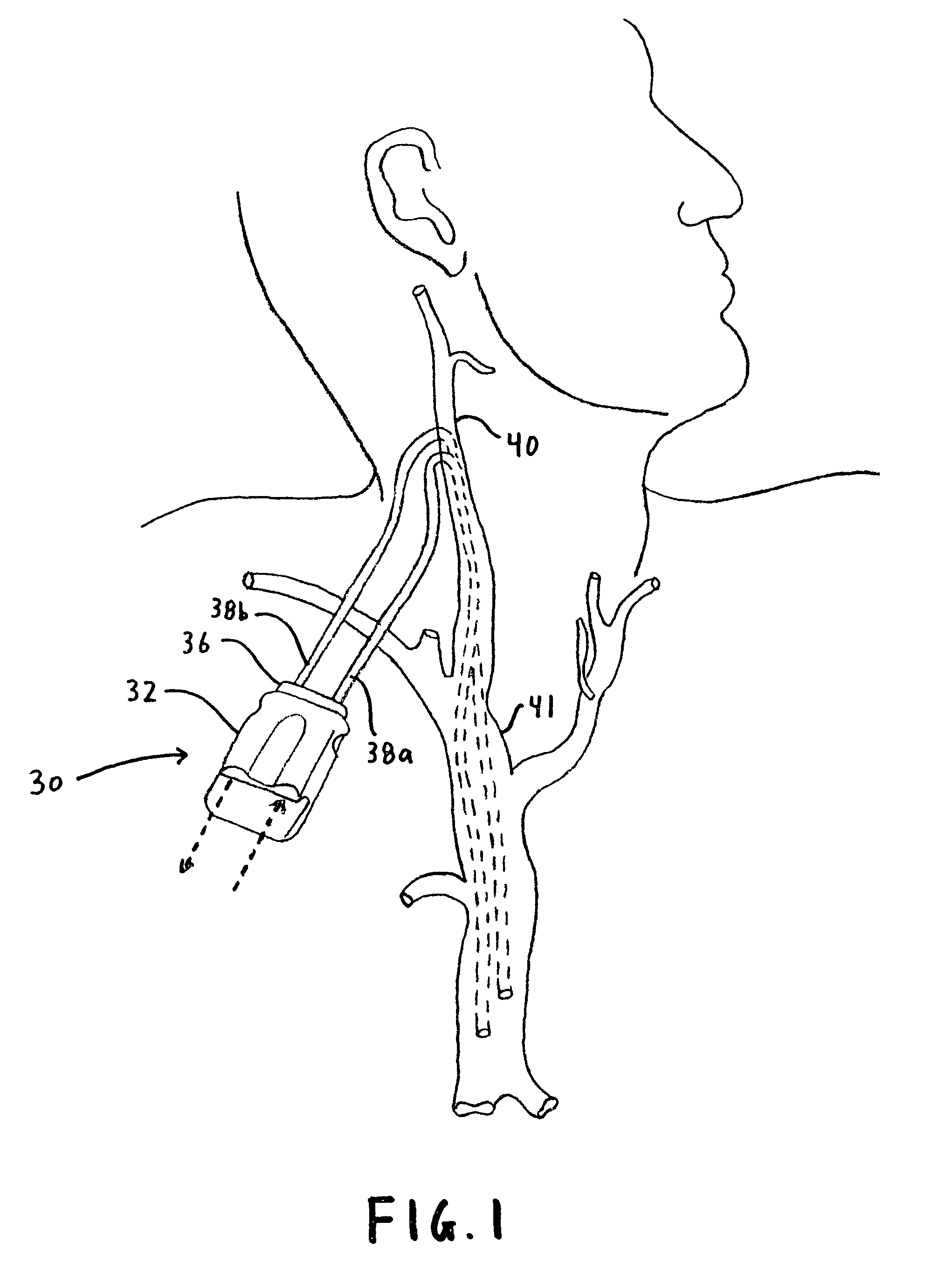 Port device for subcutaneous access to the vascular system of a patient