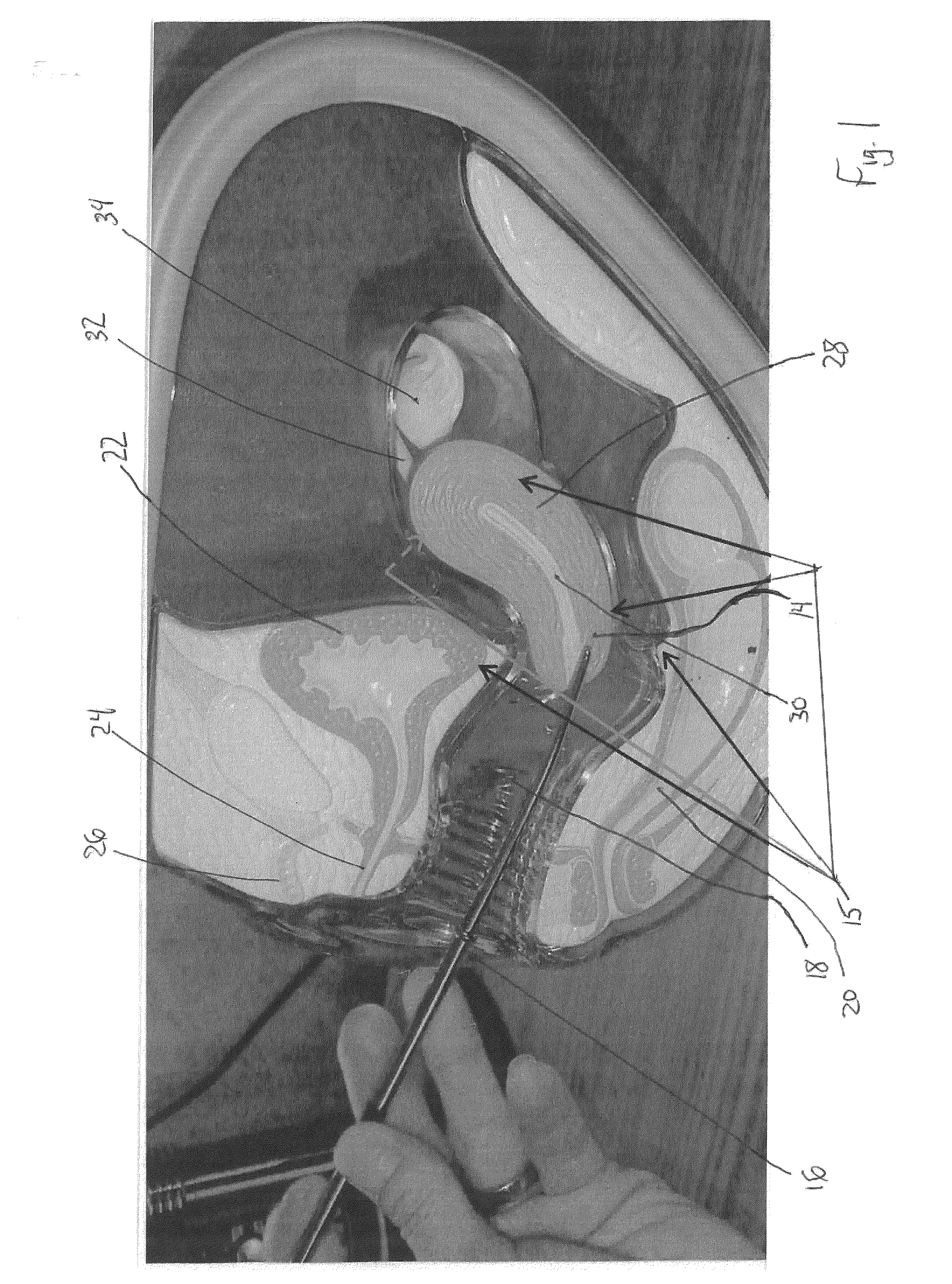 Cervical dilator