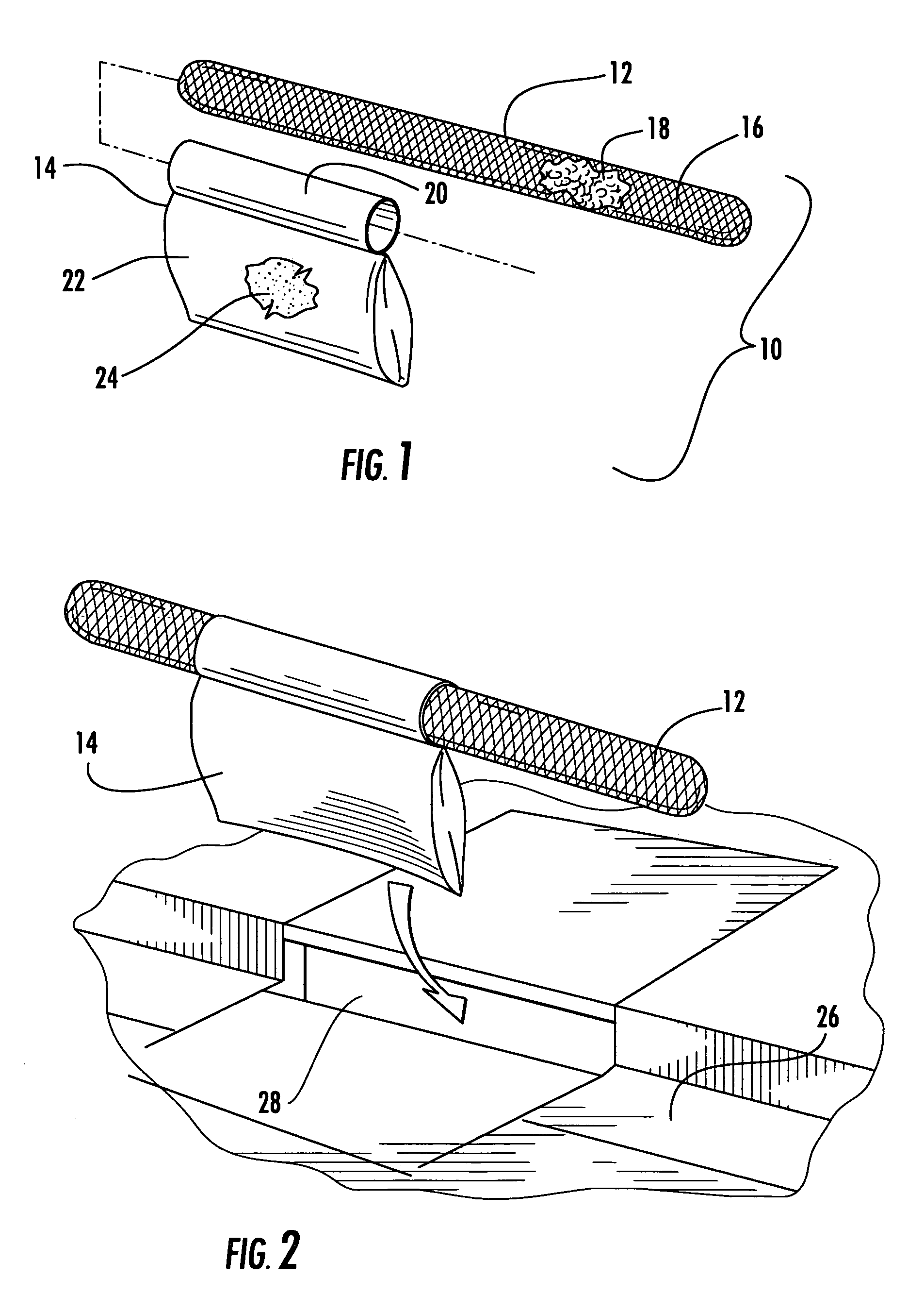 System for filtering stormwater-carried debris flowing through a gutter inlet into a catch basin