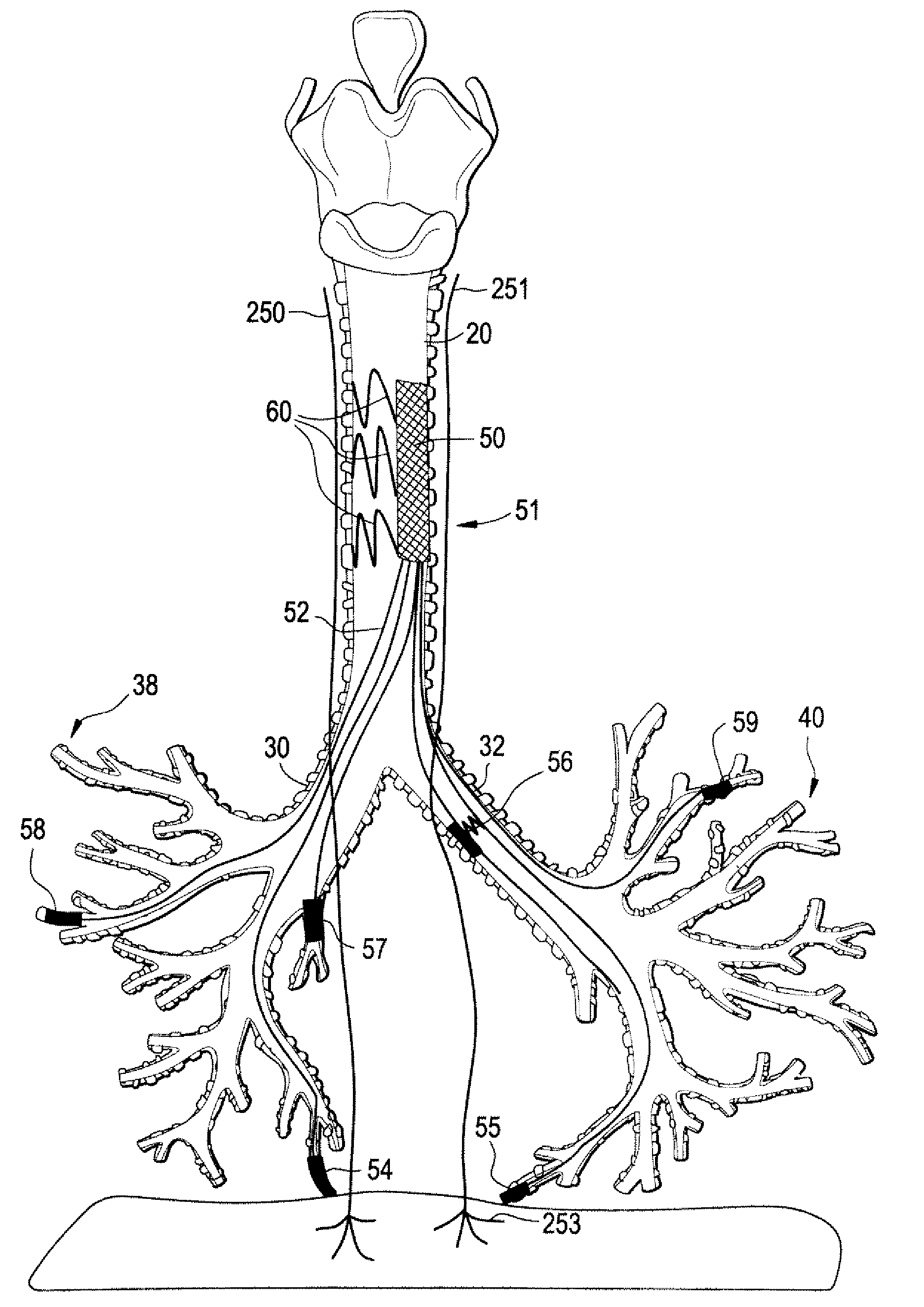 Devices and methods for electrical stimulation of the diaphragm and nerves