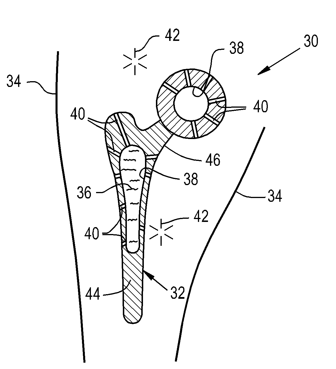 Drug delivery implants