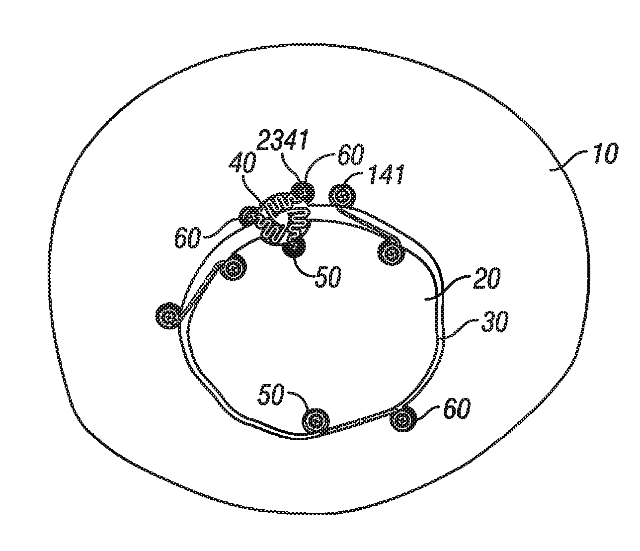 Cranial plating and bur hole cover system and methods of use