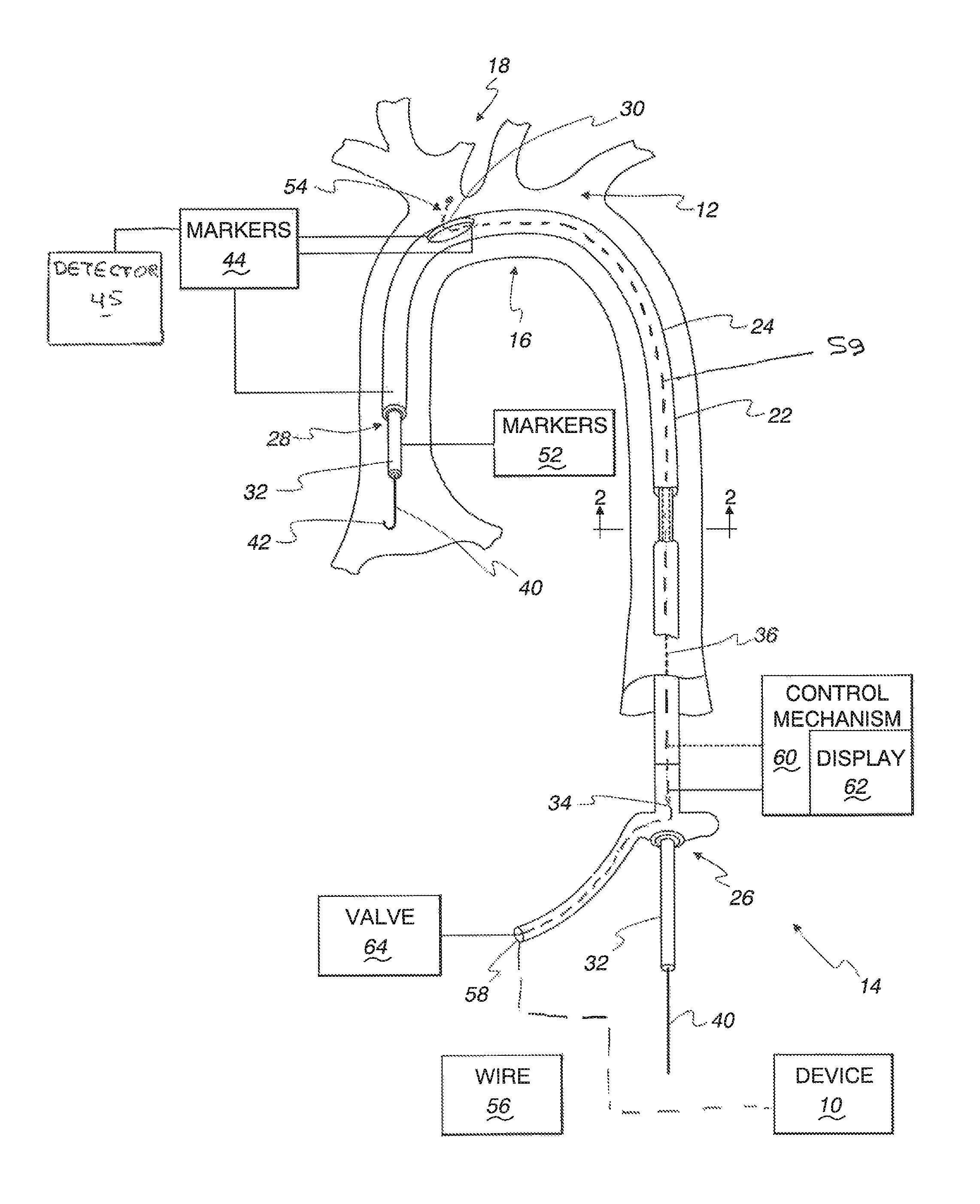 Method of controllably directing a device into a human vessel