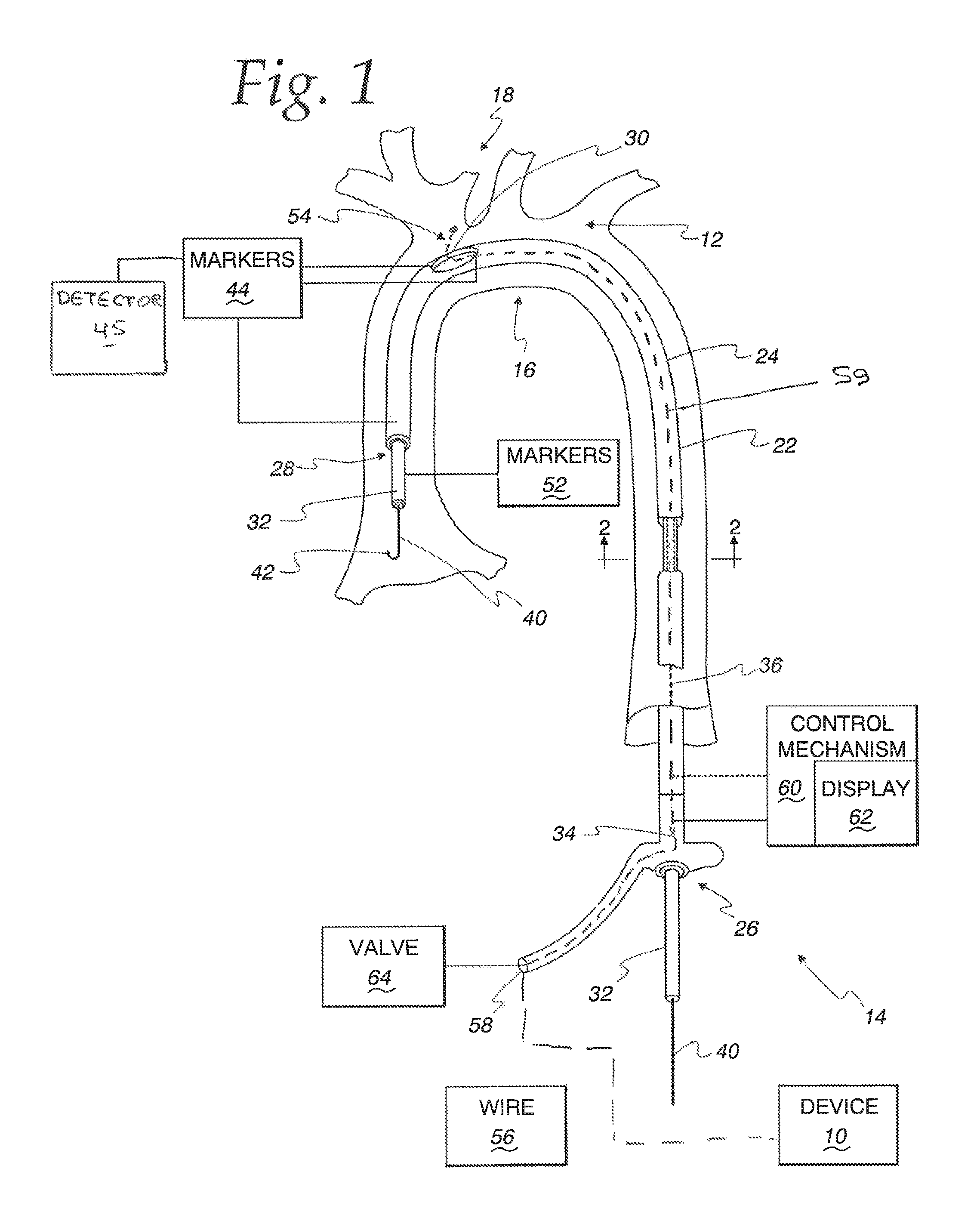 Method of controllably directing a device into a human vessel