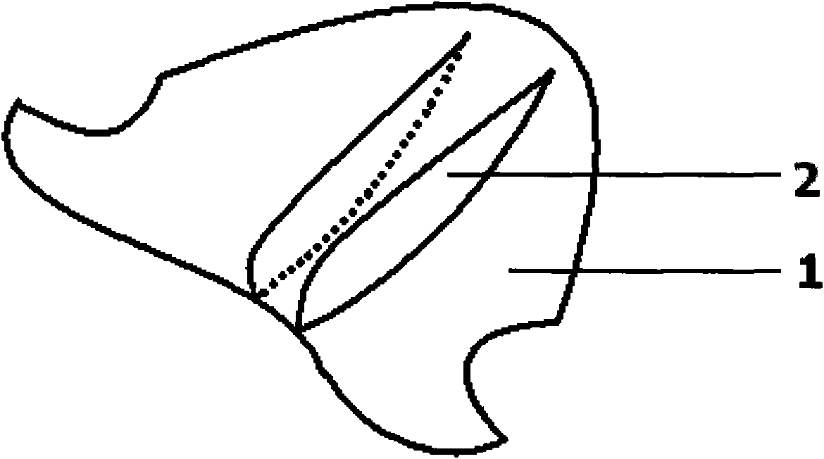 Biteplate for improving trigeminal noxious inhibitory-stress relief system and using method thereof