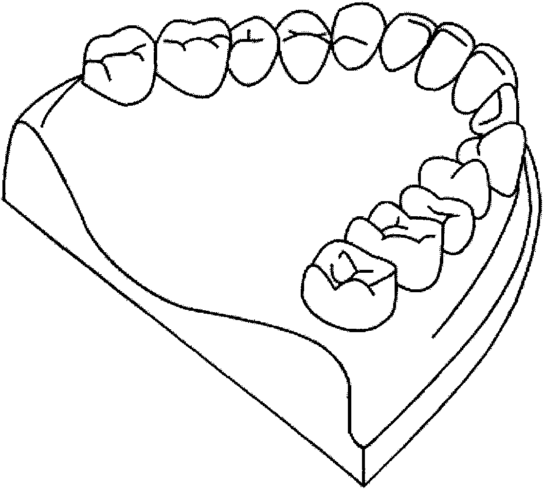 Biteplate for improving trigeminal noxious inhibitory-stress relief system and using method thereof