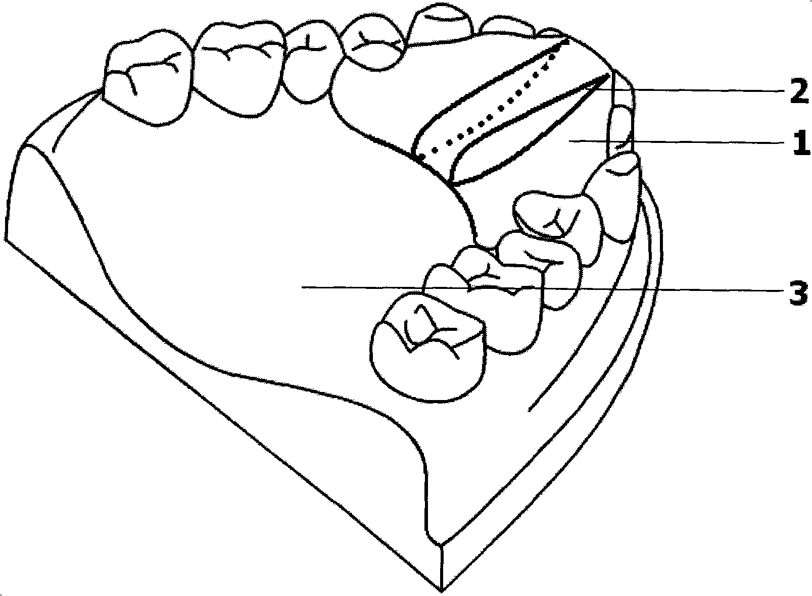 Biteplate for improving trigeminal noxious inhibitory-stress relief system and using method thereof