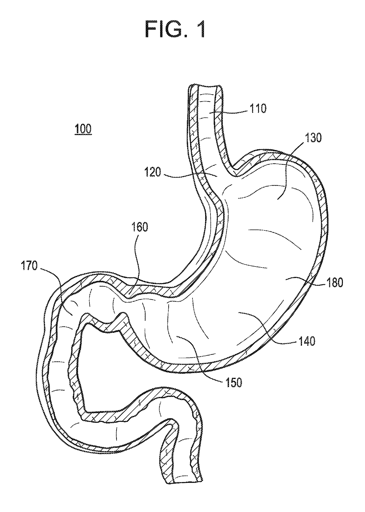 Passive caloric bypass device