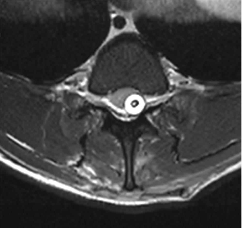 Adjustable macaque spinal cord injury method