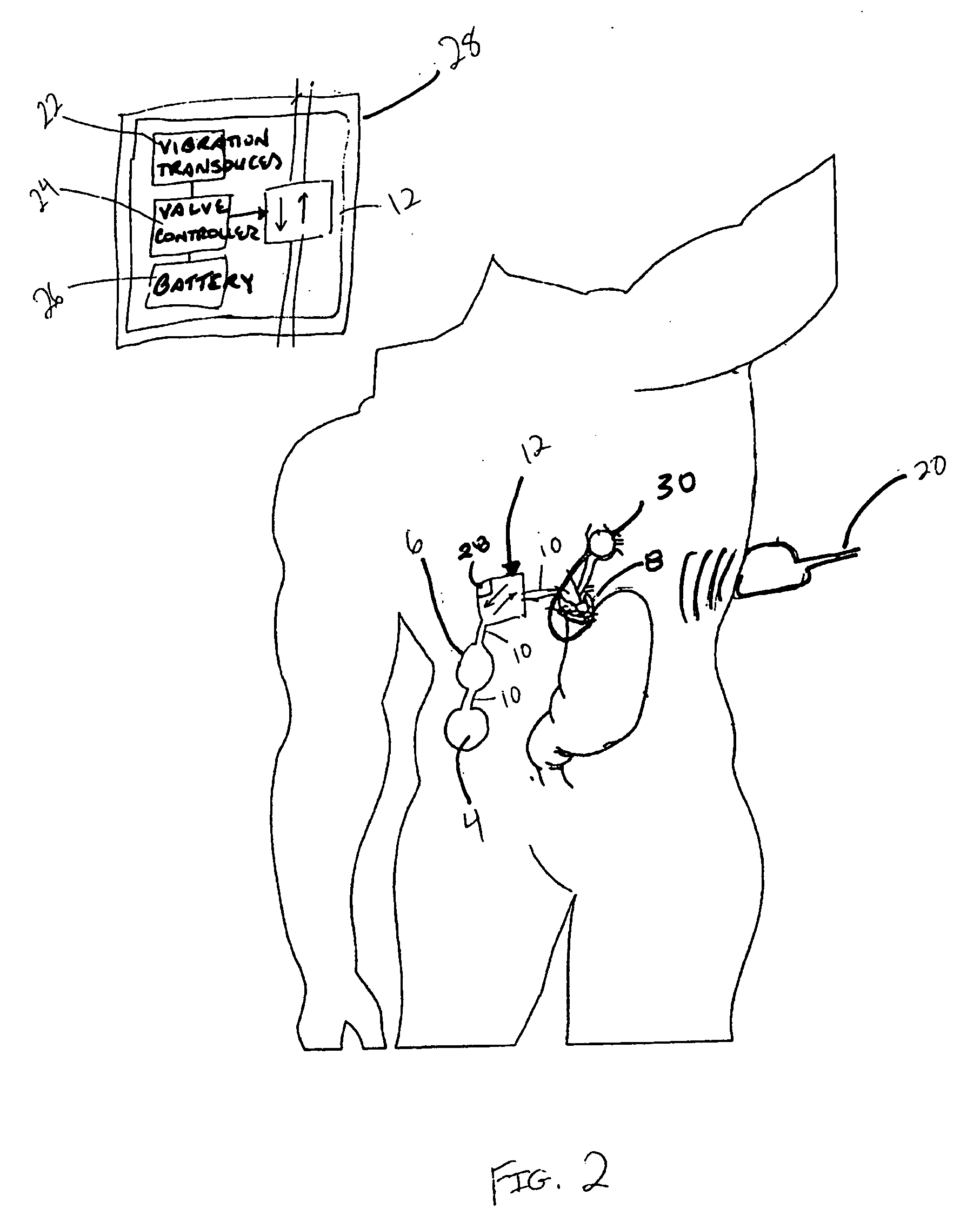 Implantable adjustable sphincter system