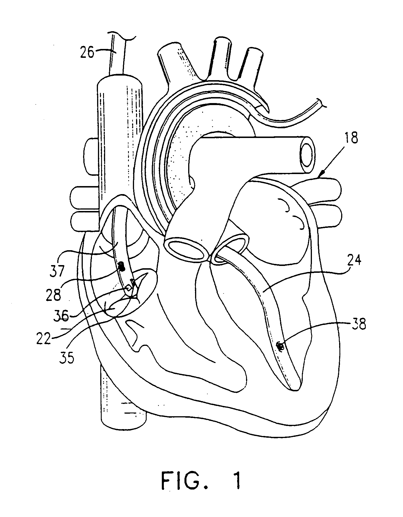 Medical system using implantable sensor in bone for determining position coordinates