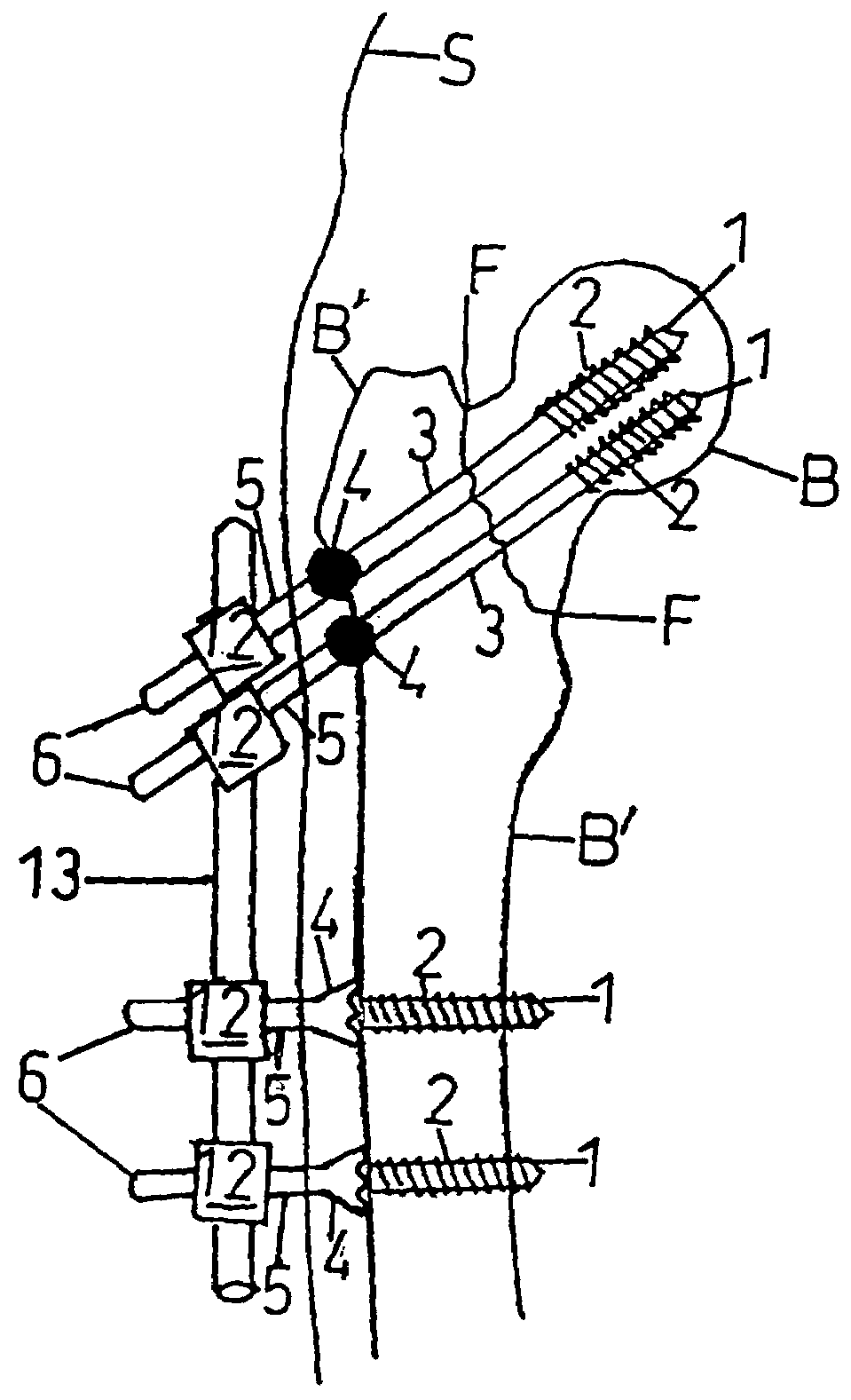 Renew compression screw