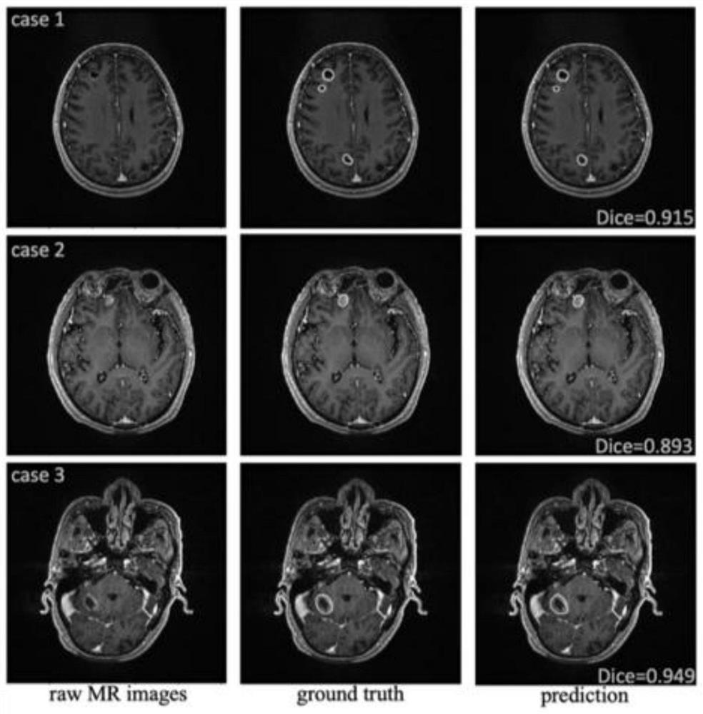 Deep coagulation population P system and method for brain metastatic tumor mixed supervised learning