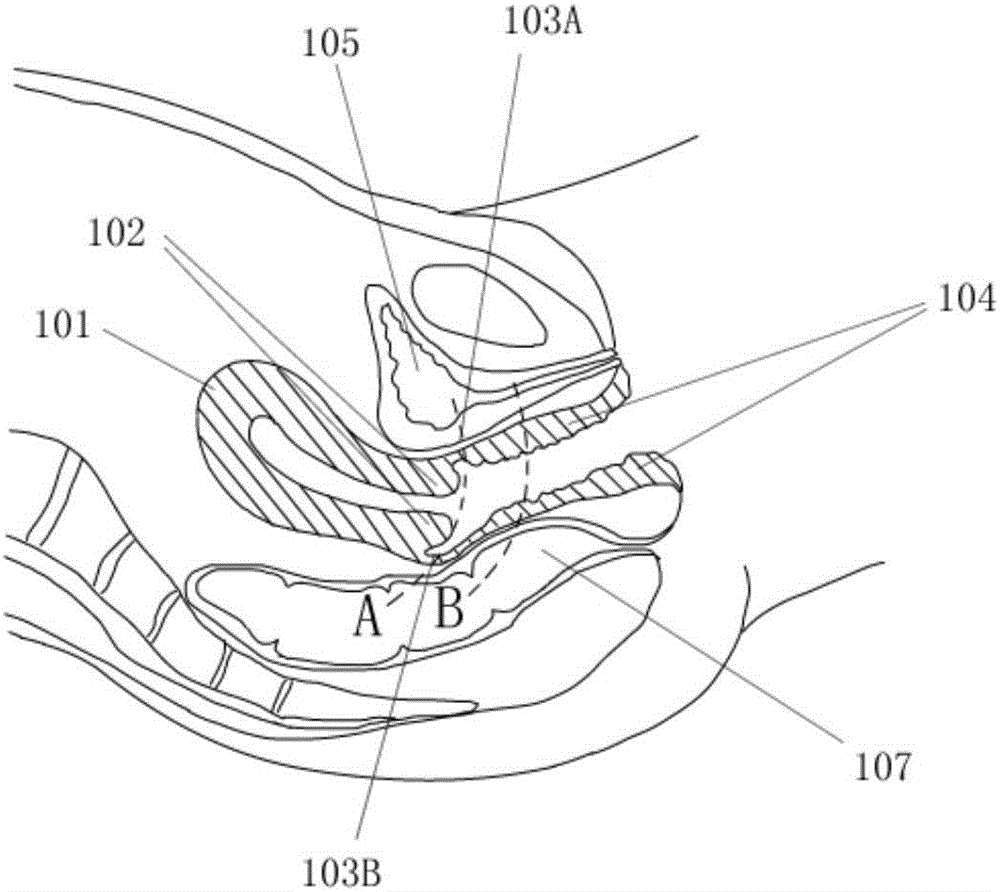 Disposable balloon uterine manipulator