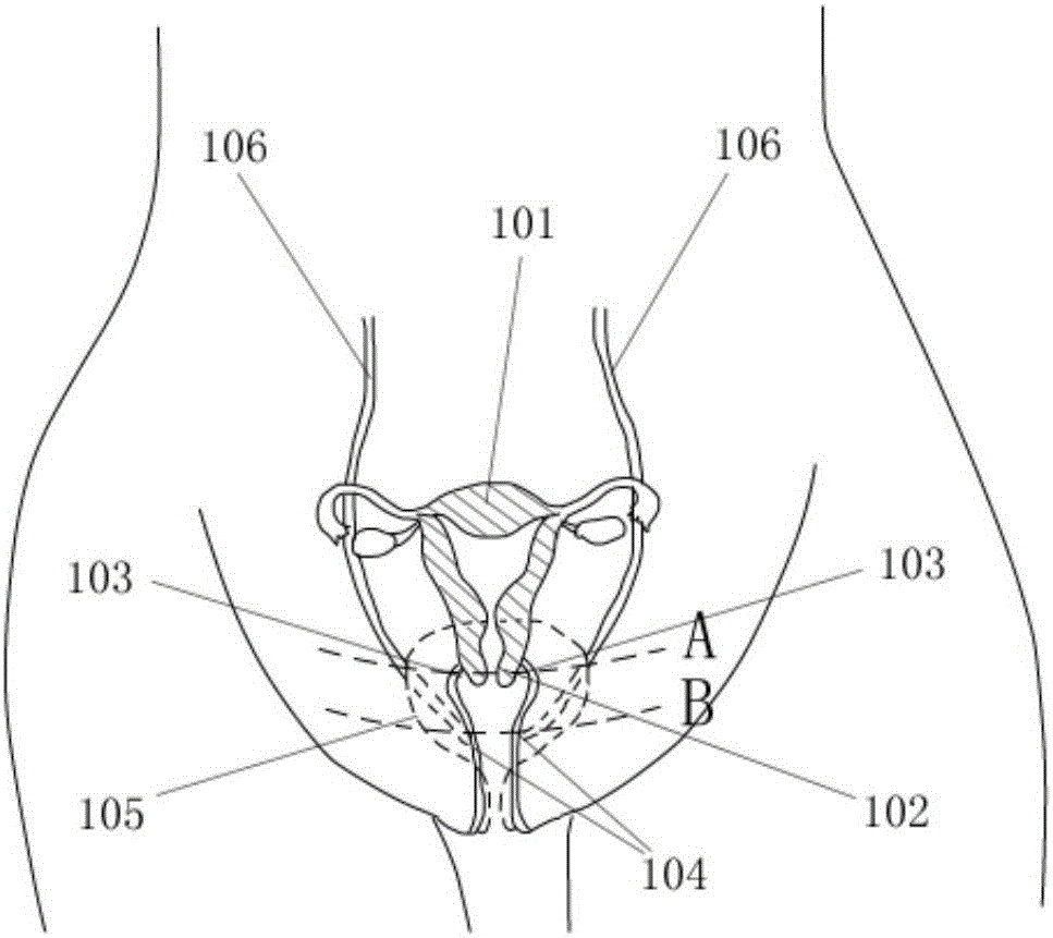 Disposable balloon uterine manipulator