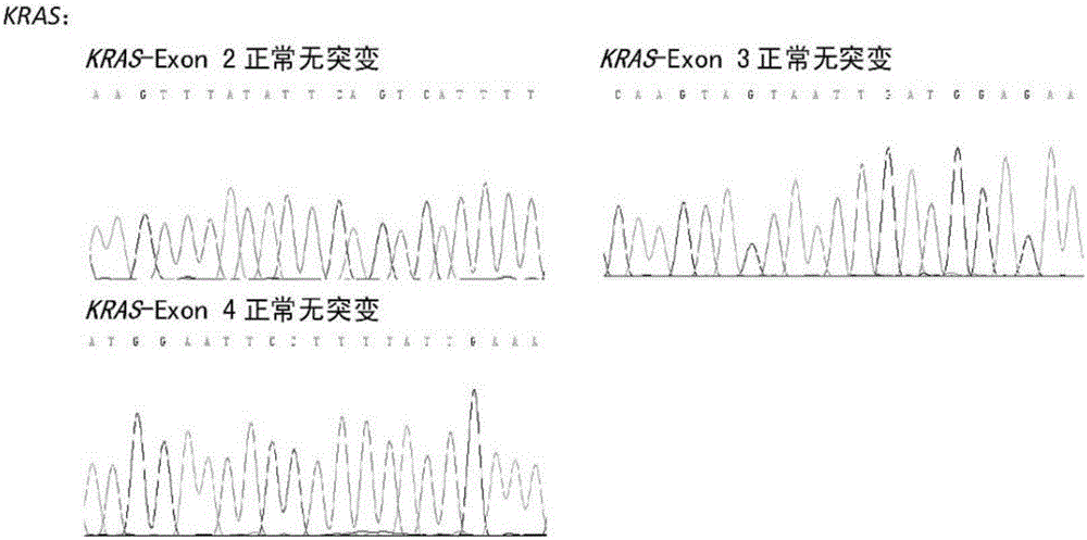 Multiple myeloma (MM) prognosis related gene mutation detection kit and detection method