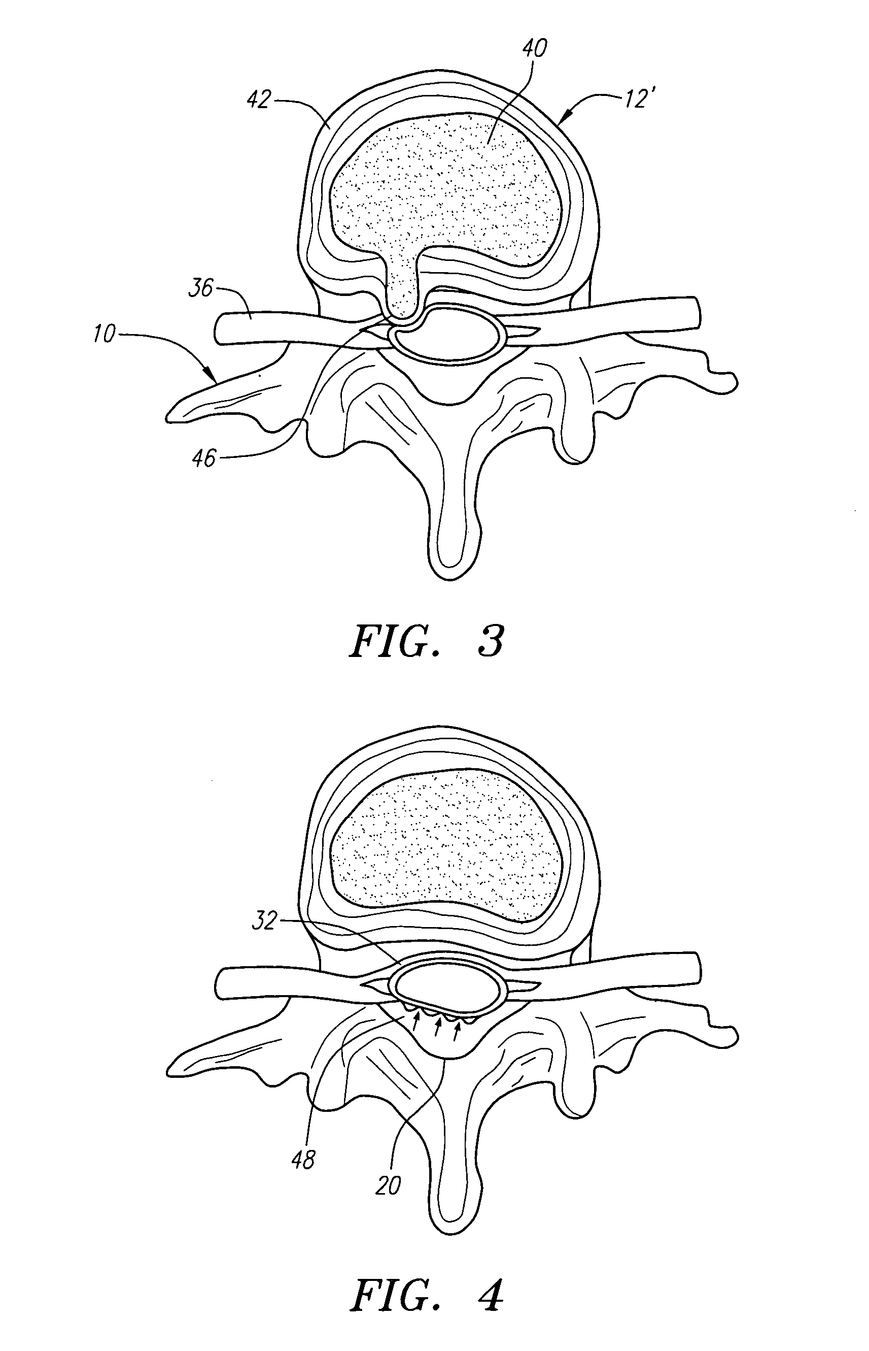 Apparatus and methods for removing vertebral bone and disc tissue