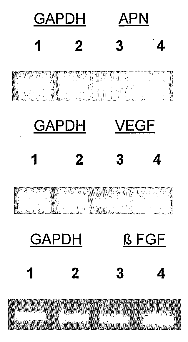 Inhibition of Wet Type Age Related Macular Degeneration (Amd) by Adiponectin or Acrp 30