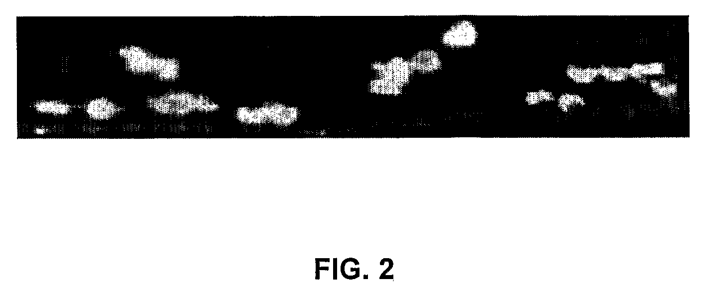 Inhibition of Wet Type Age Related Macular Degeneration (Amd) by Adiponectin or Acrp 30