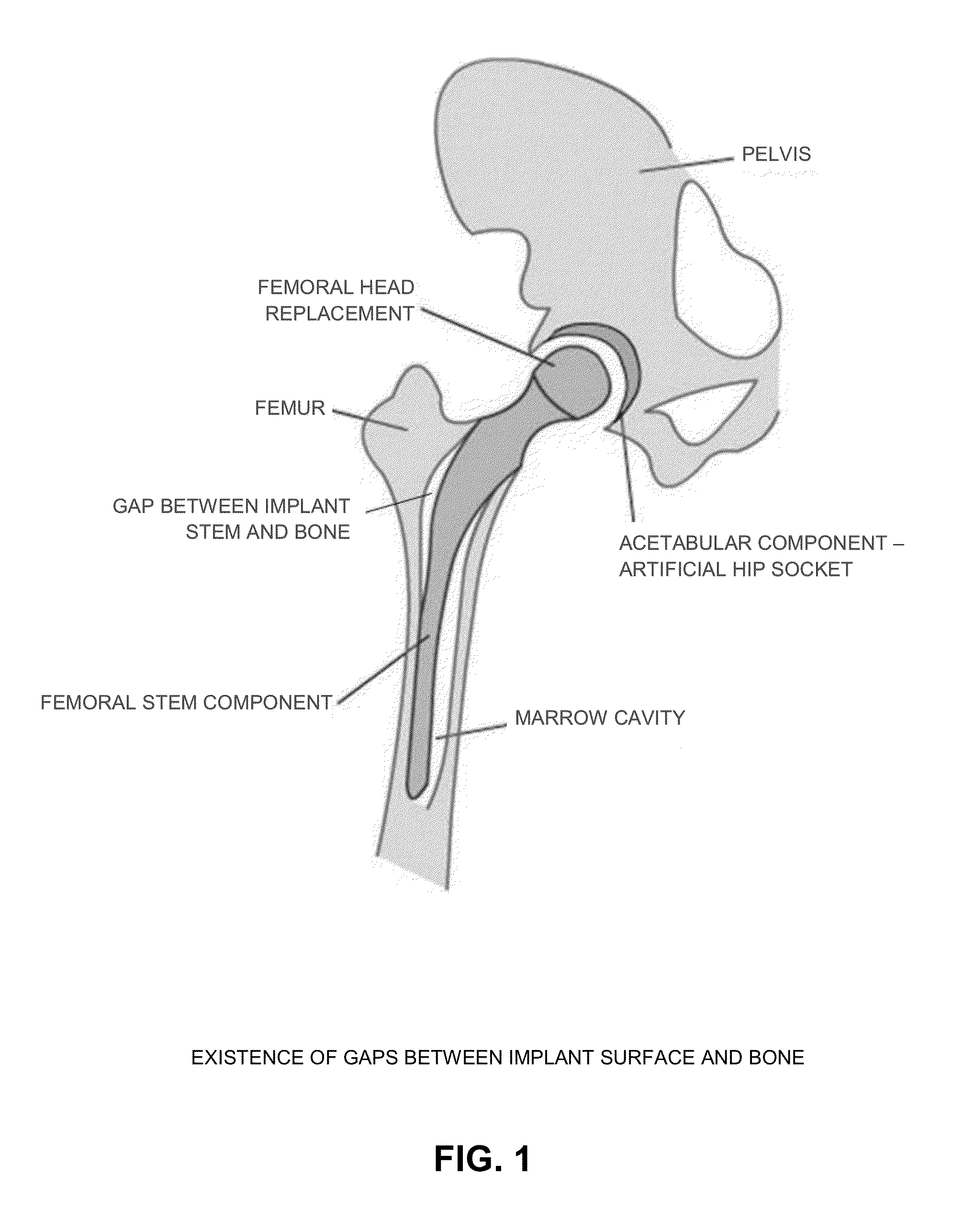 Dynamic porous coating for orthopedic implant