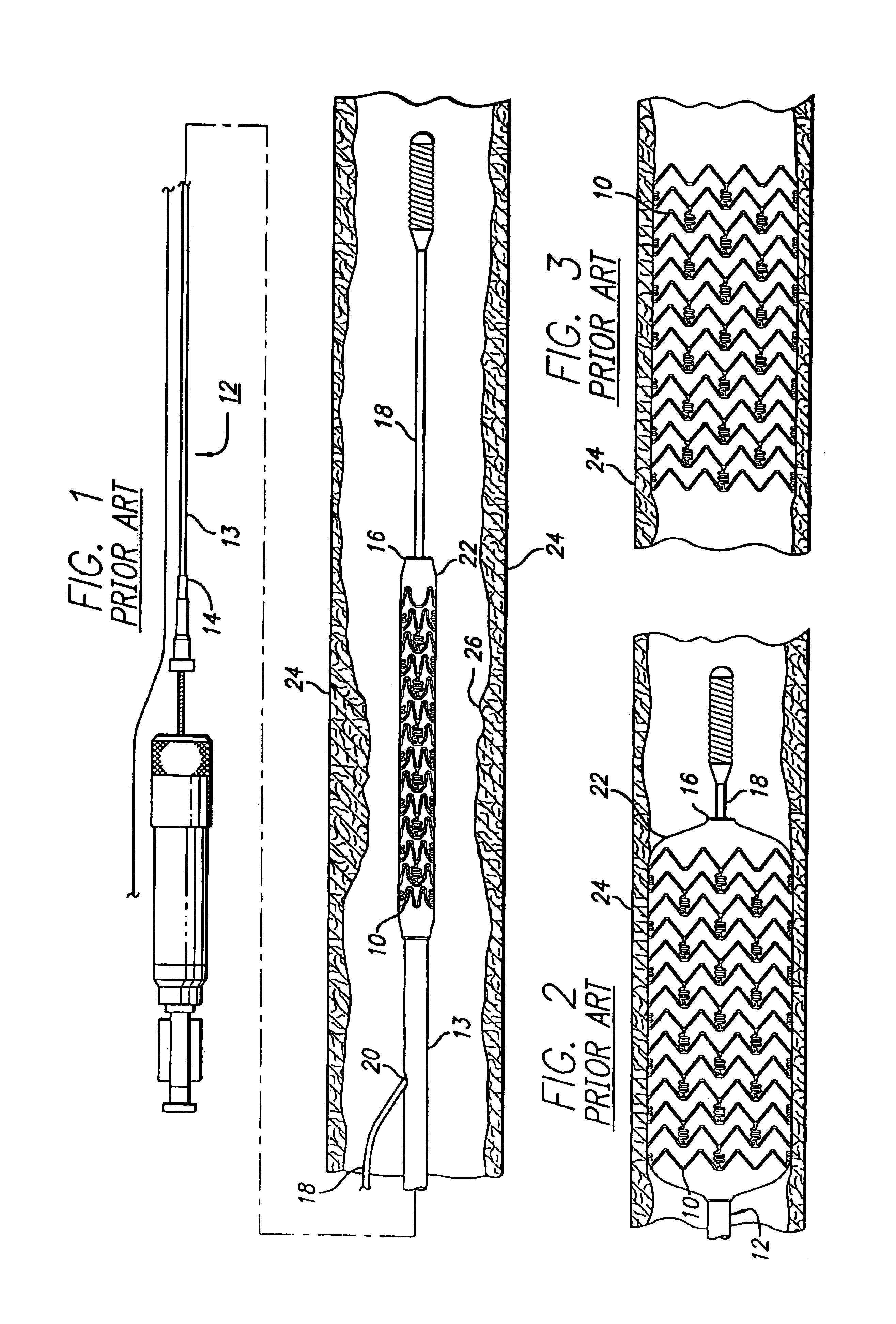 Intravascular stent