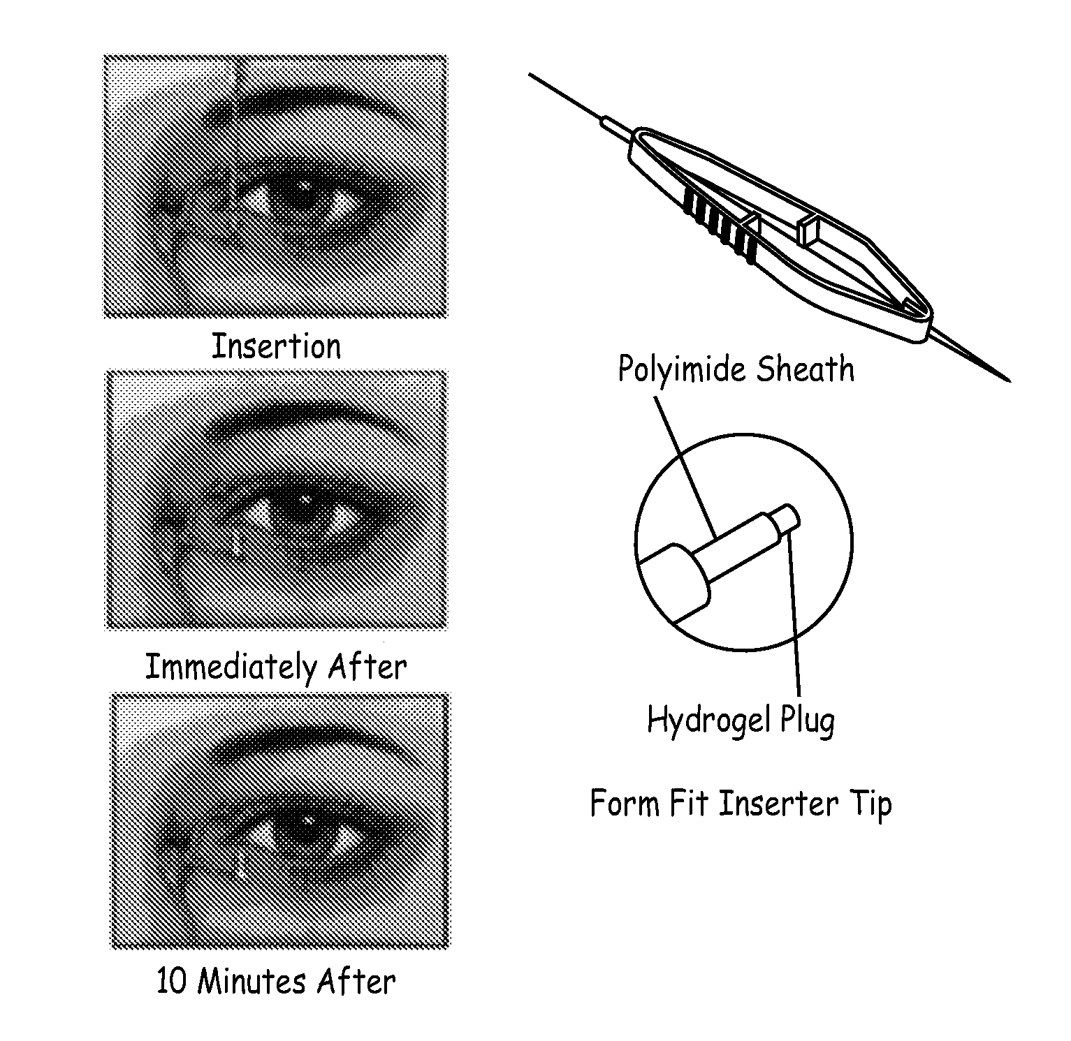 Drug delivery through hydrogel plugs