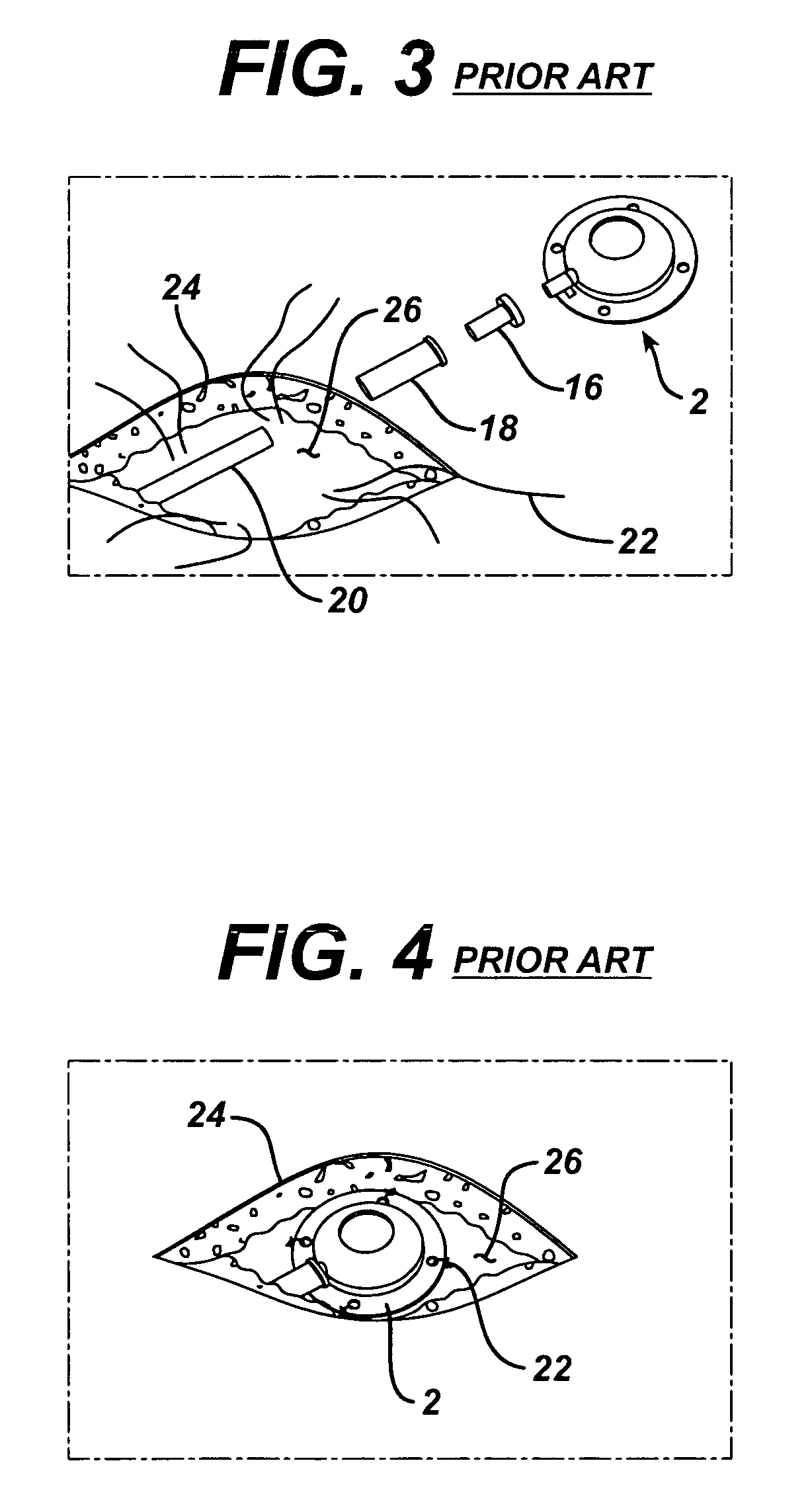 Subcutaneous injection port with stabilizing elements